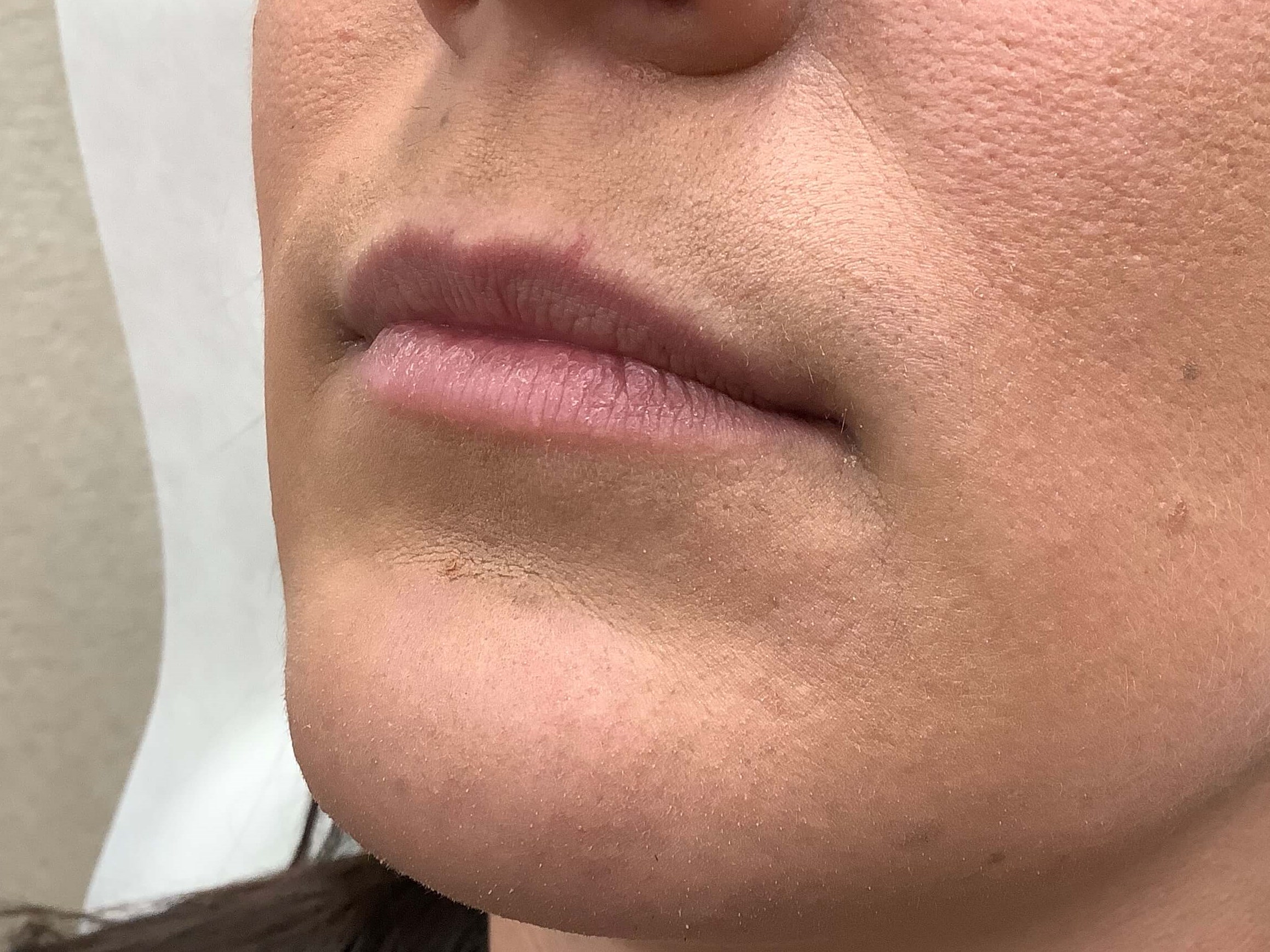 Before and After JUVÉDERM® Photos