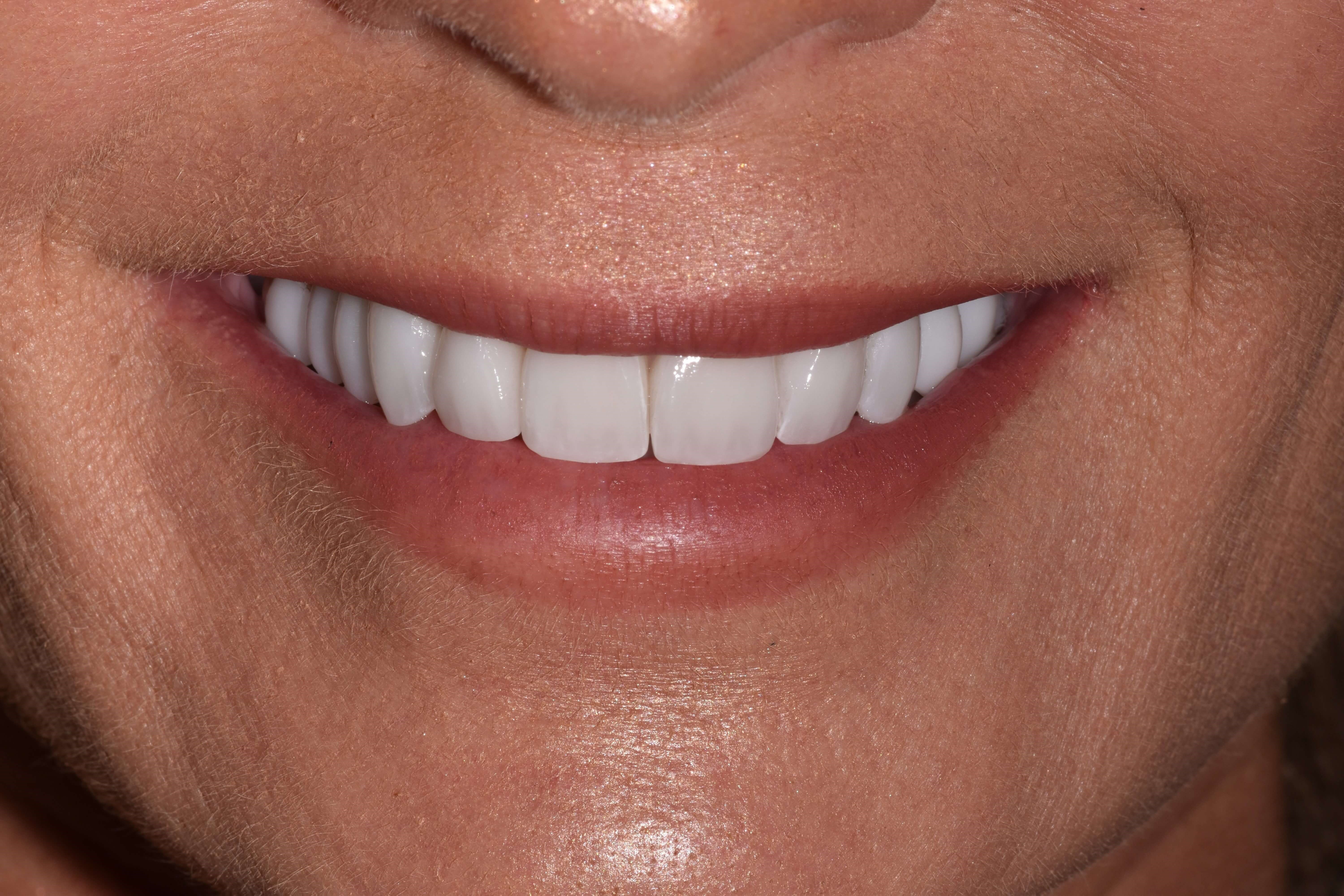 Porcelain Crowns After