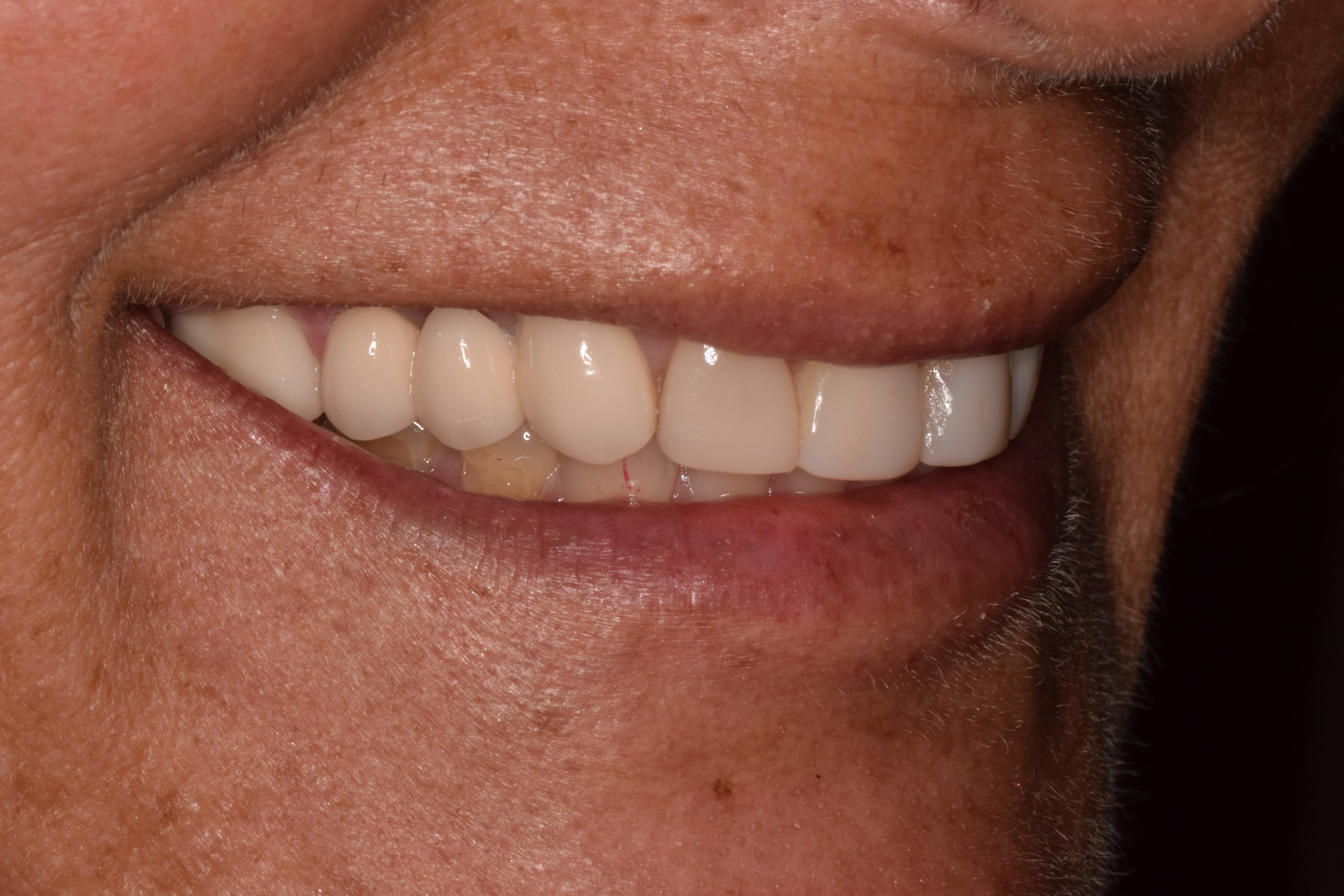 Porcelain Crowns Before