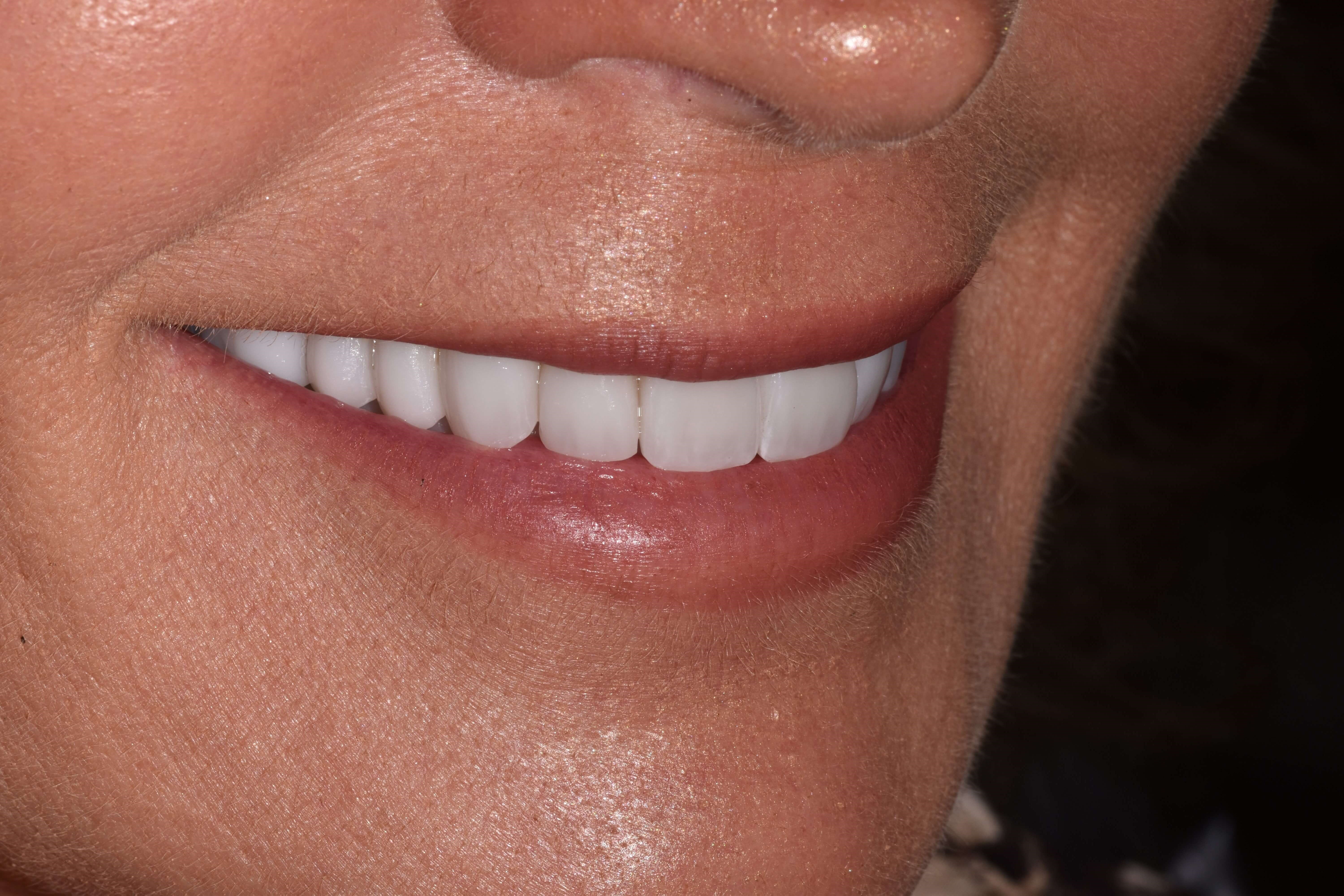 Porcelain Crowns After