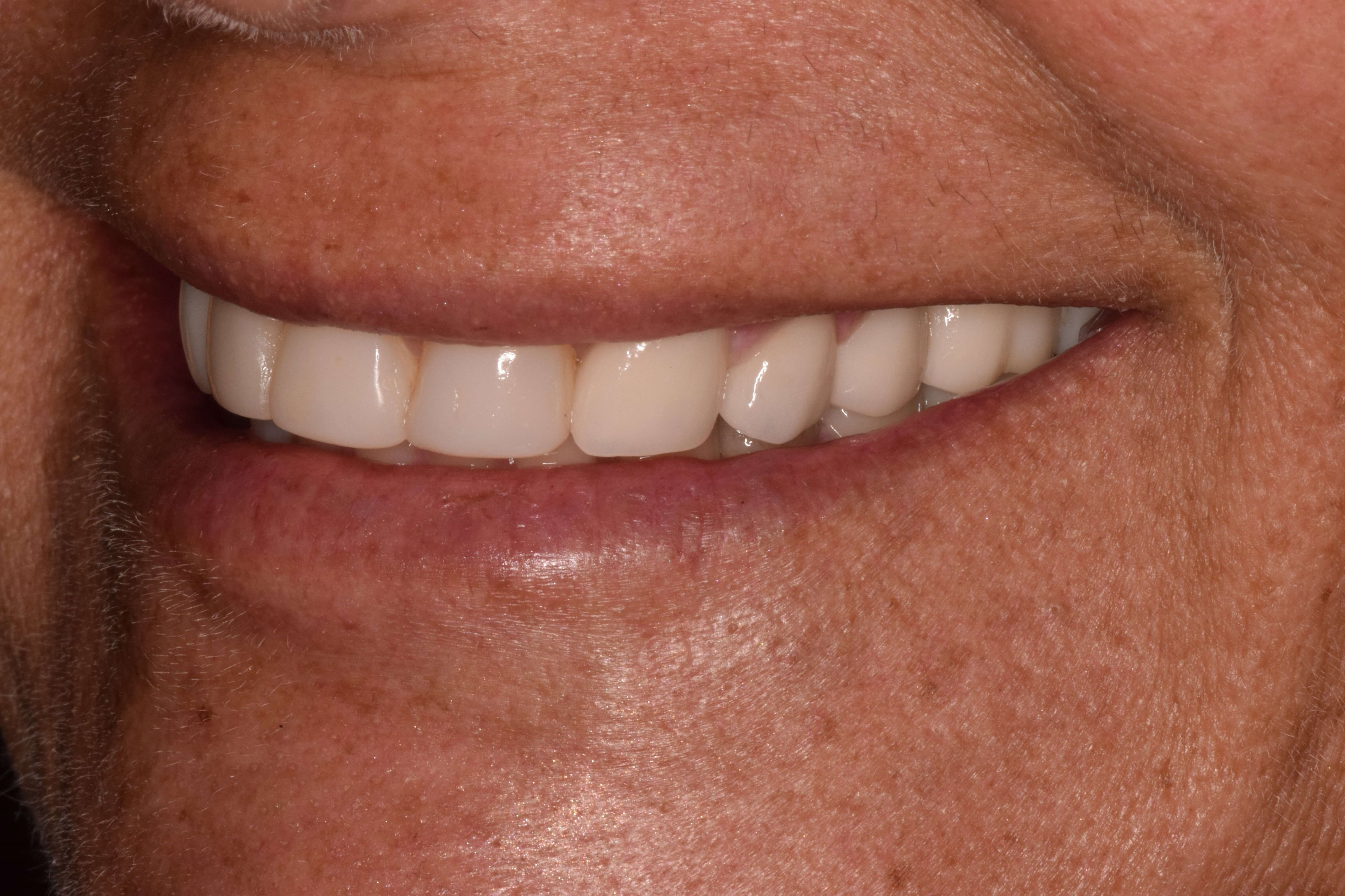 Porcelain Crowns Before