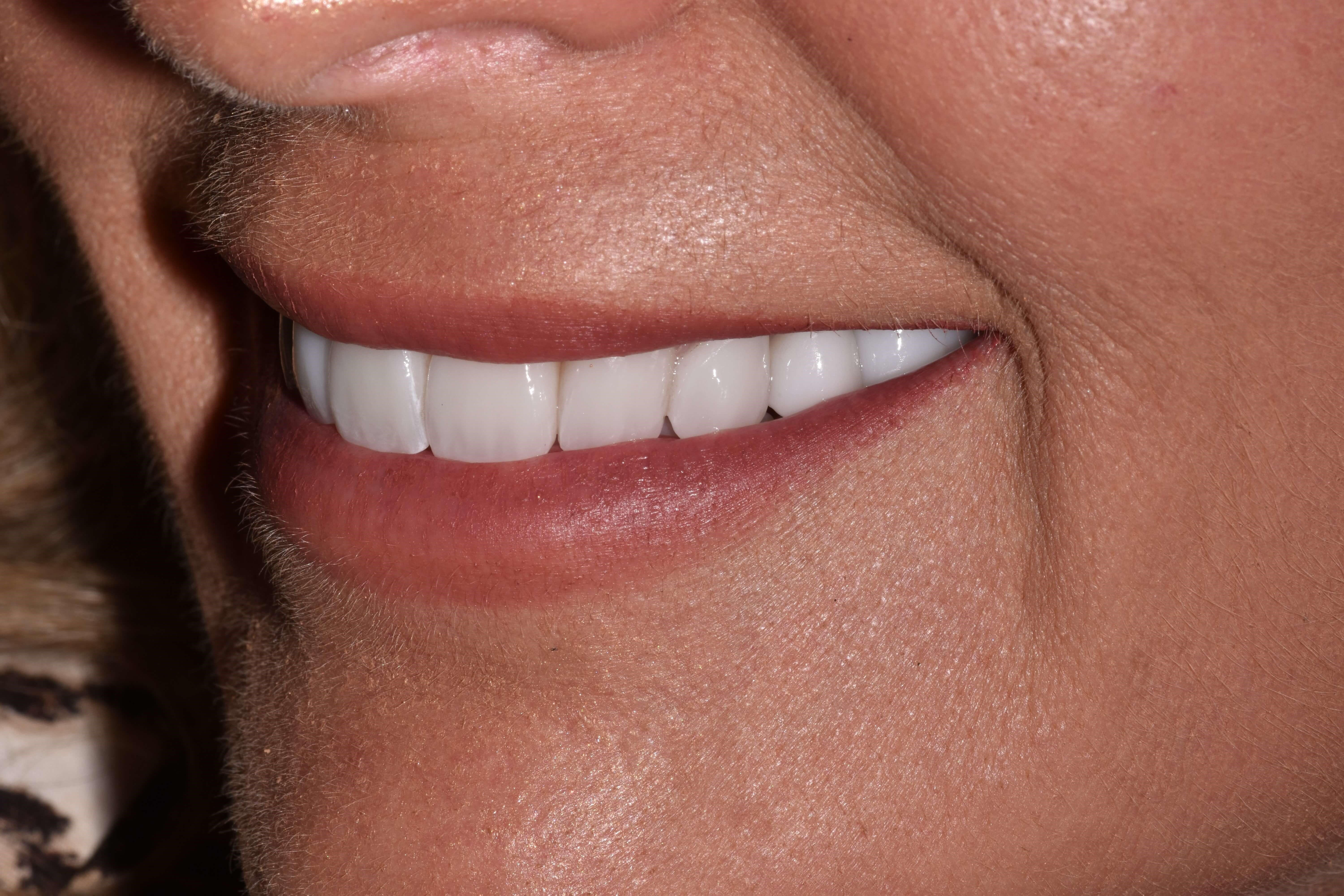 Porcelain Crowns After