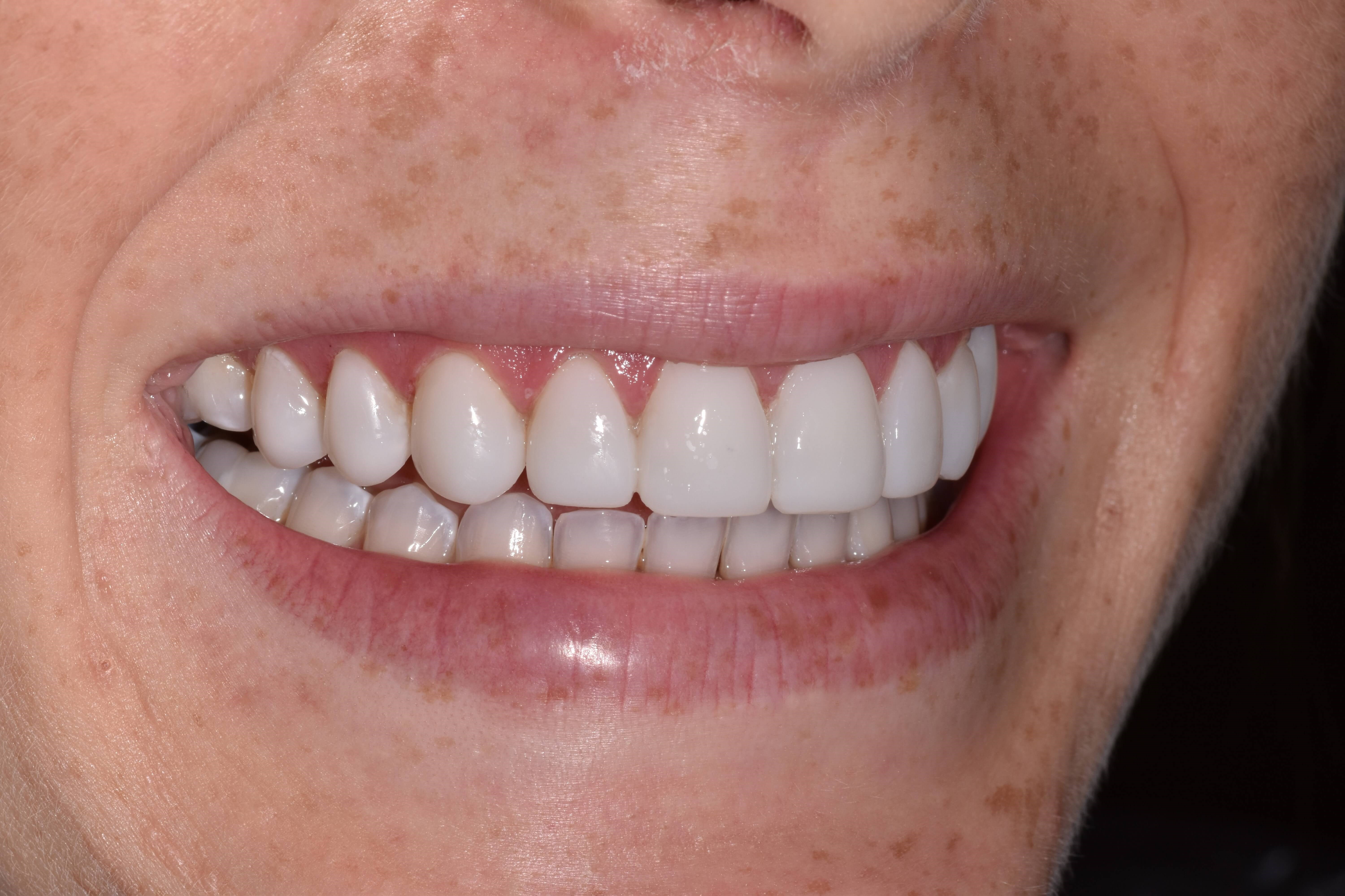 Composite Bonding After