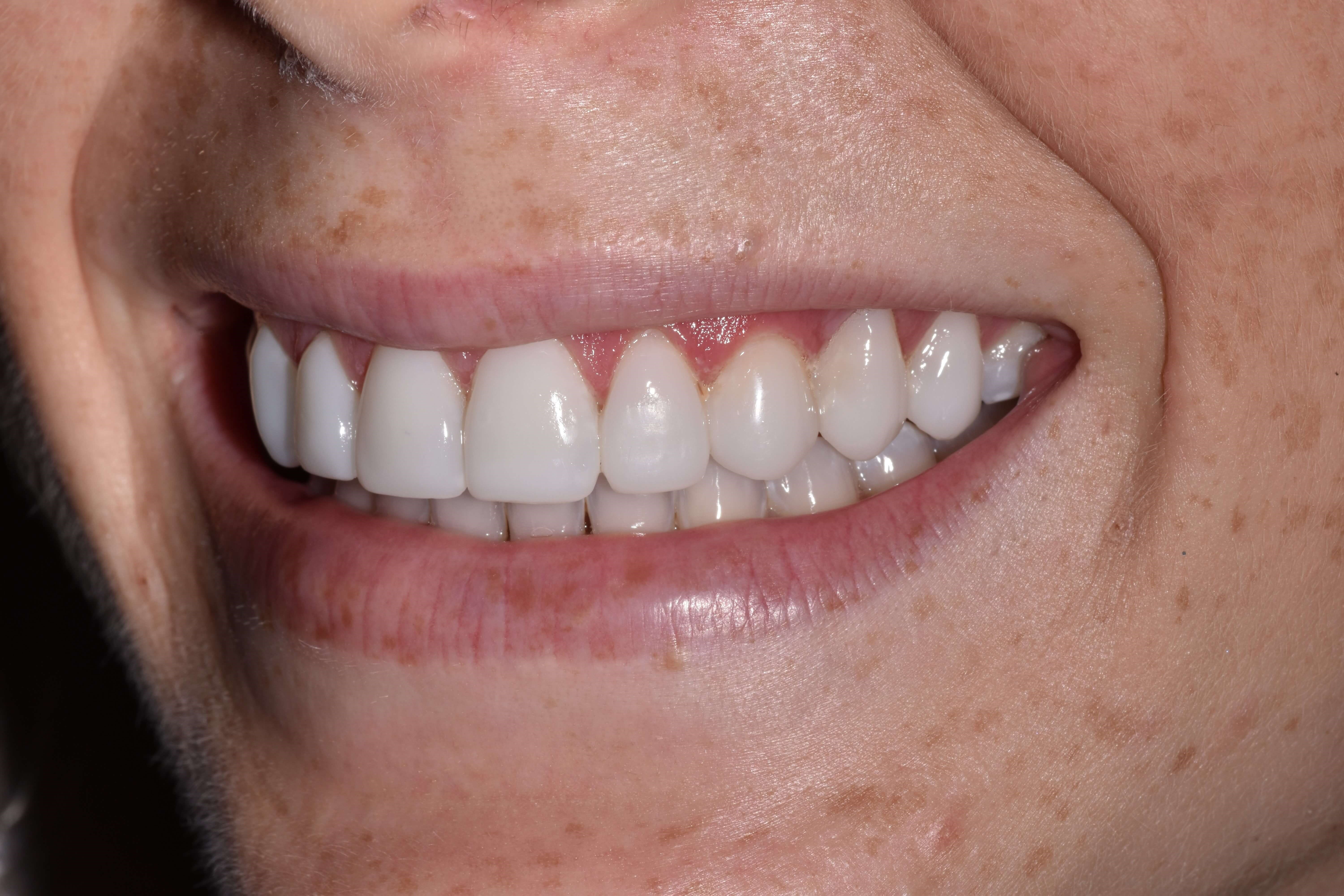 Composite Bonding After