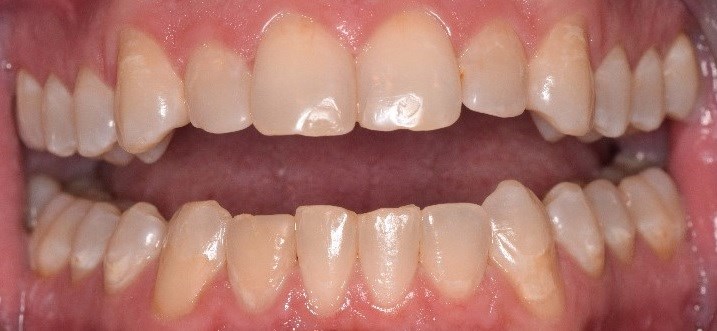 Before and After Before
