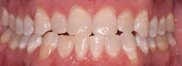 Before and After After