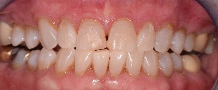 Before and After After