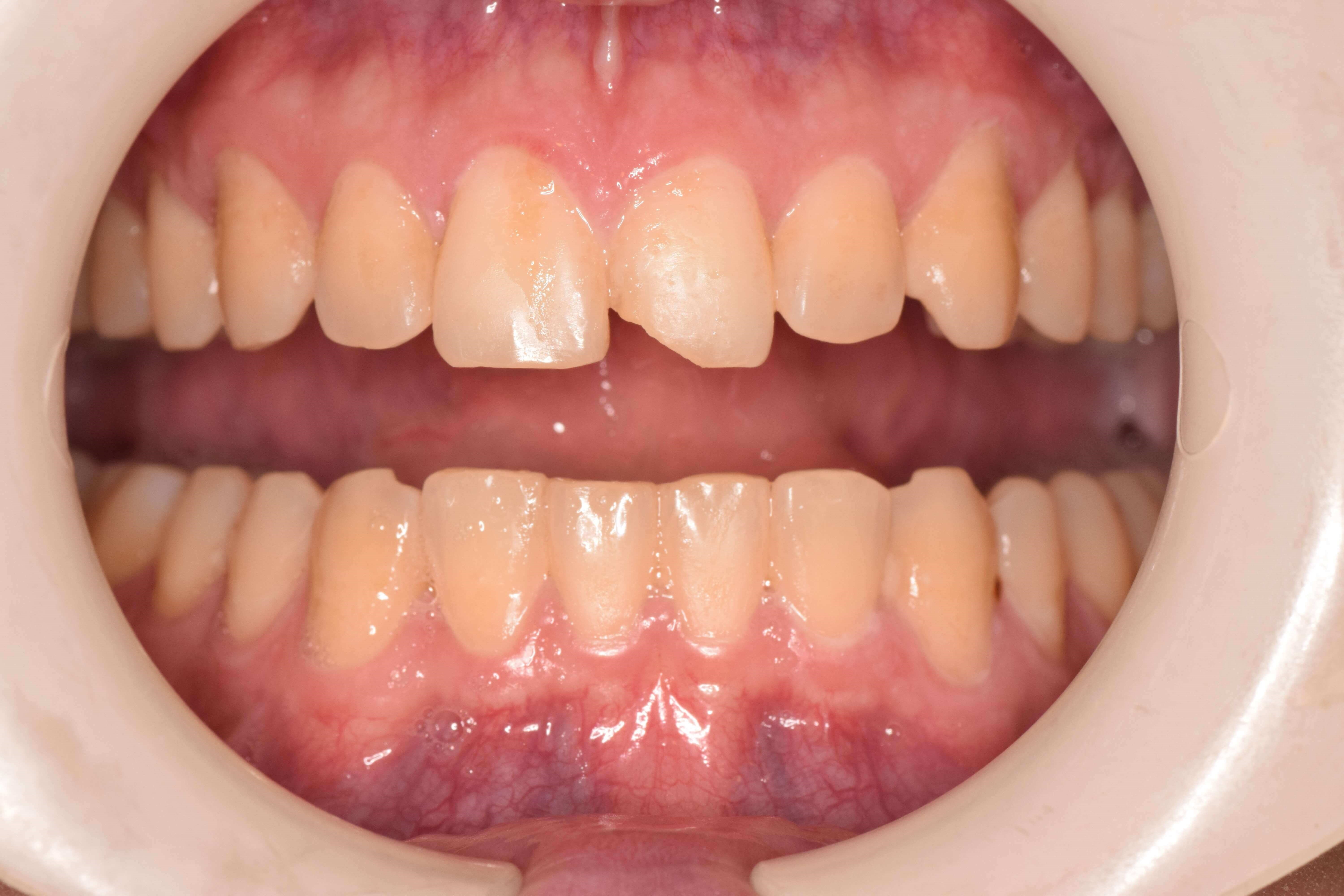 Cosmetic Bonding Before