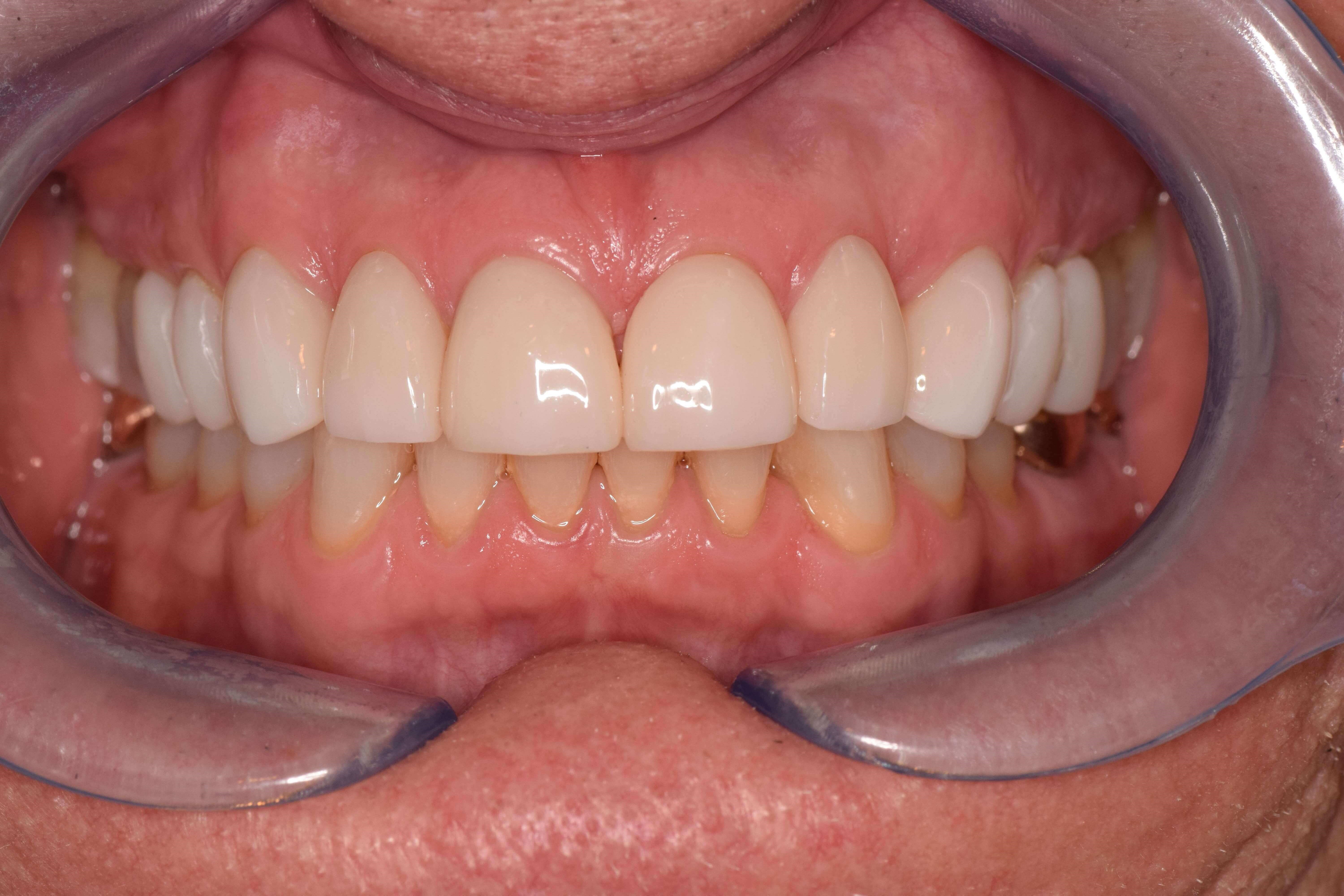 Smile Makeover After