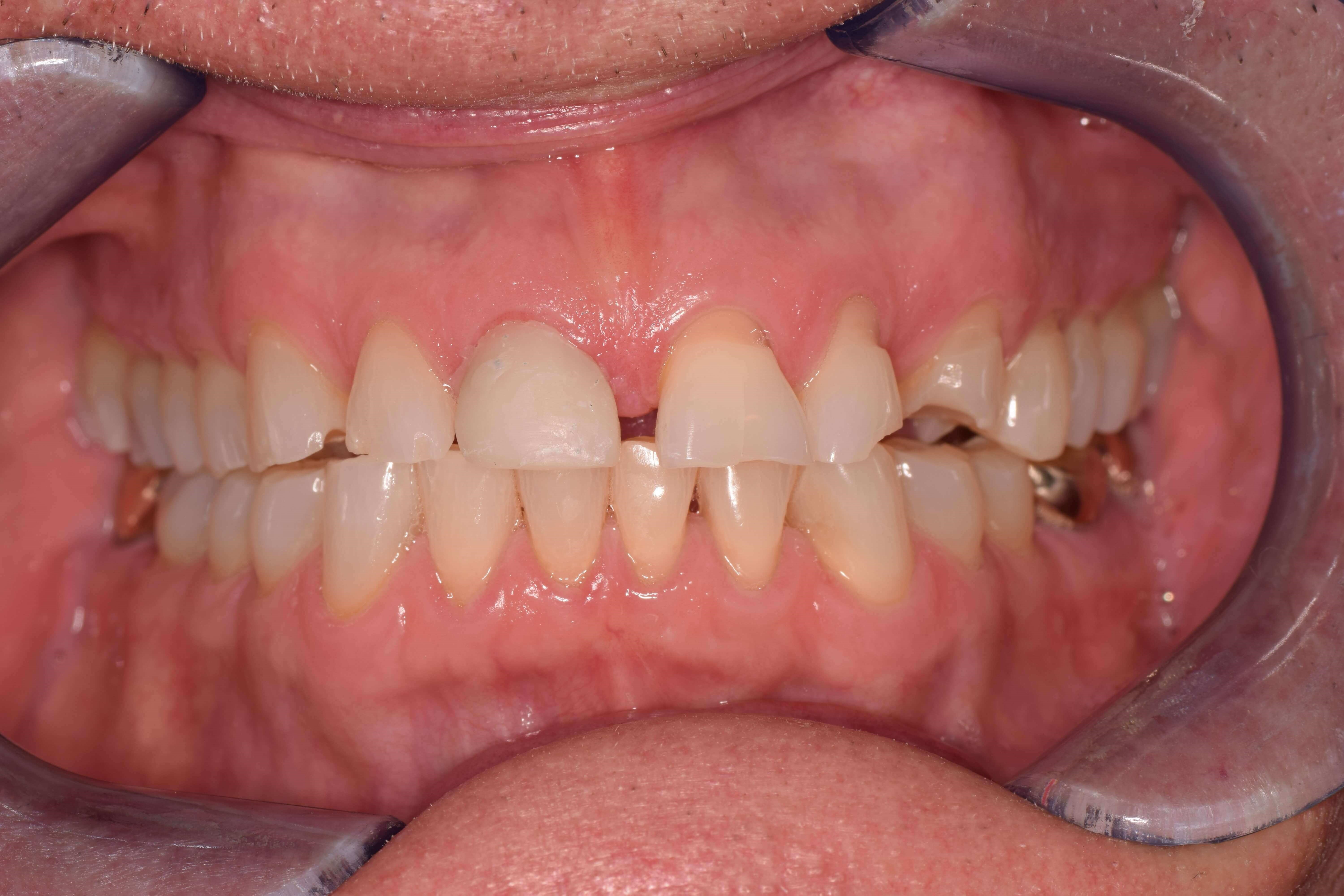 Smile Makeover Before