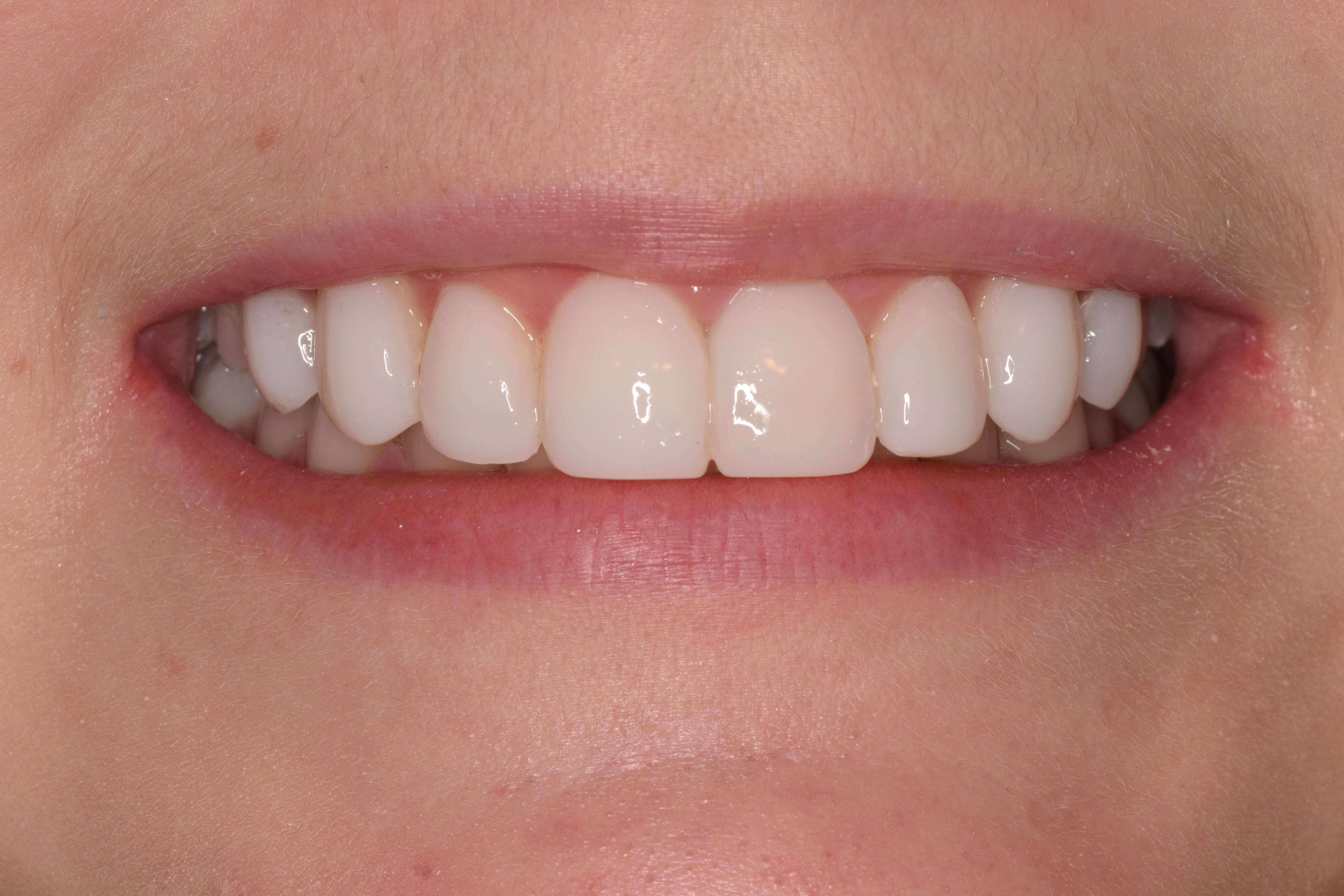 Before and After Composite Bonding & Smile Makeover Photos Before and After Composite Bonding & Smile Makeover Photos