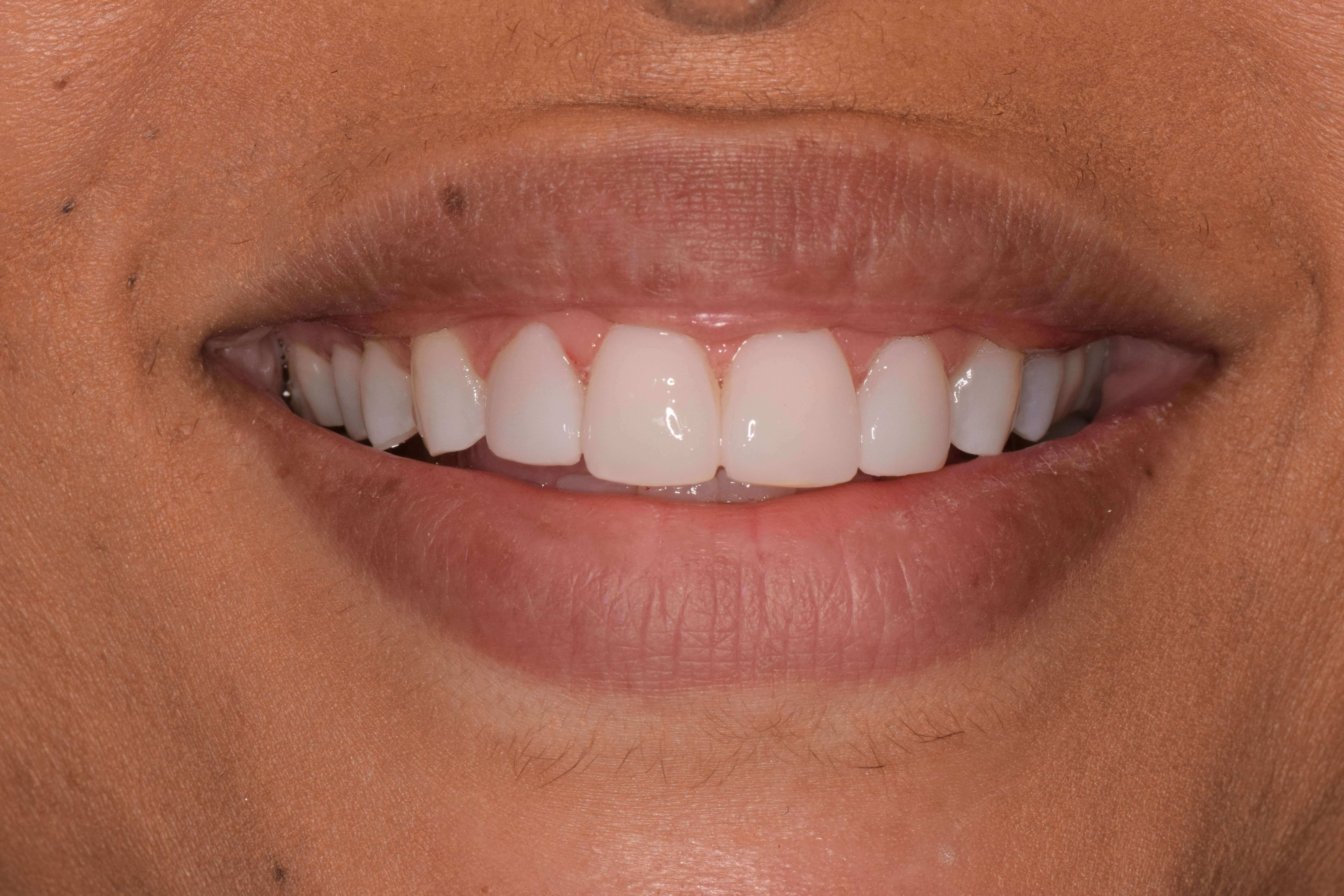 Cosmetic Bonding After