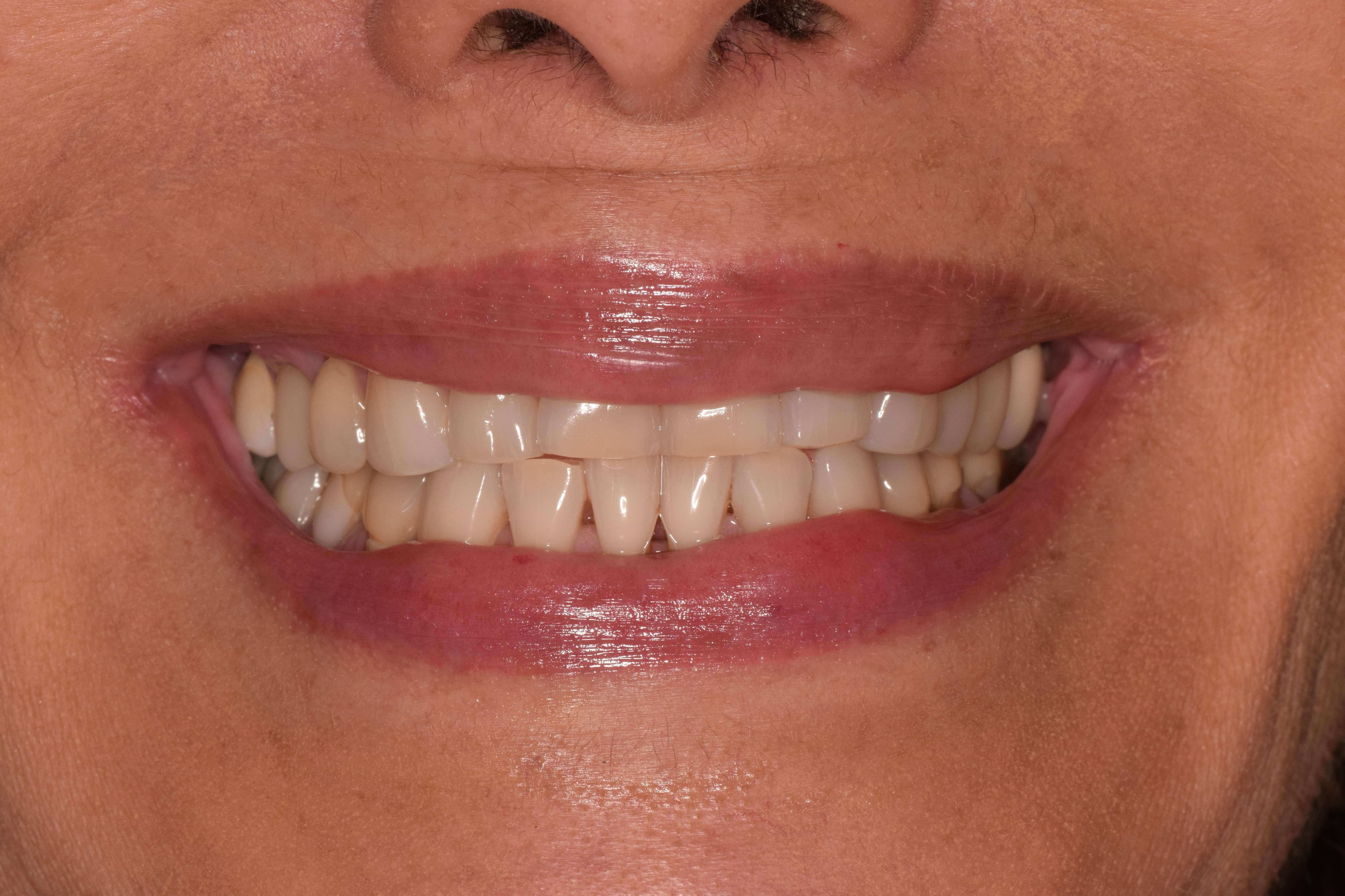 Before and After Smile Makeover & Composite Bonding Photos Before and After Smile Makeover & Composite Bonding Photos