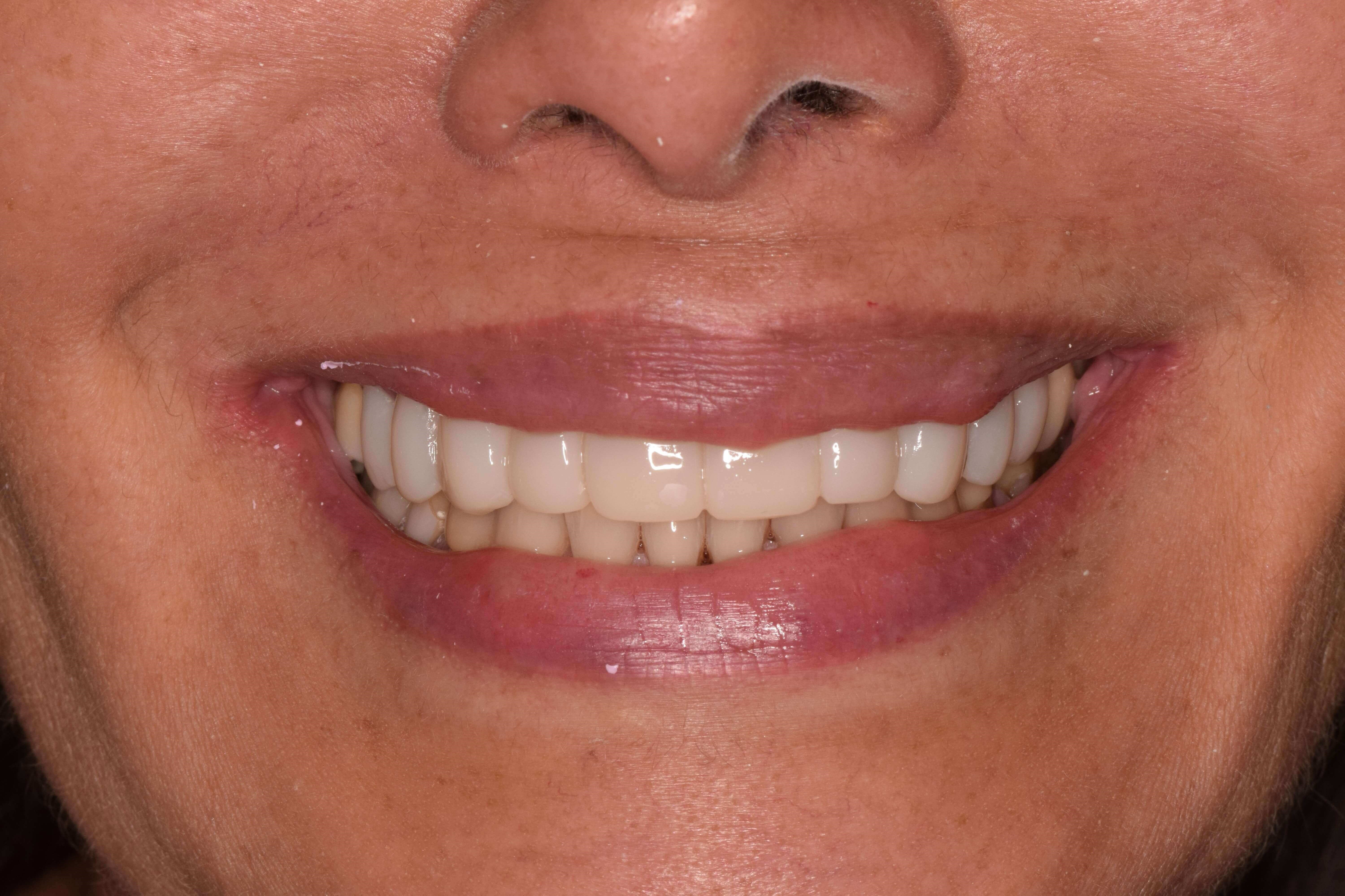 Cosmetic Bonding After