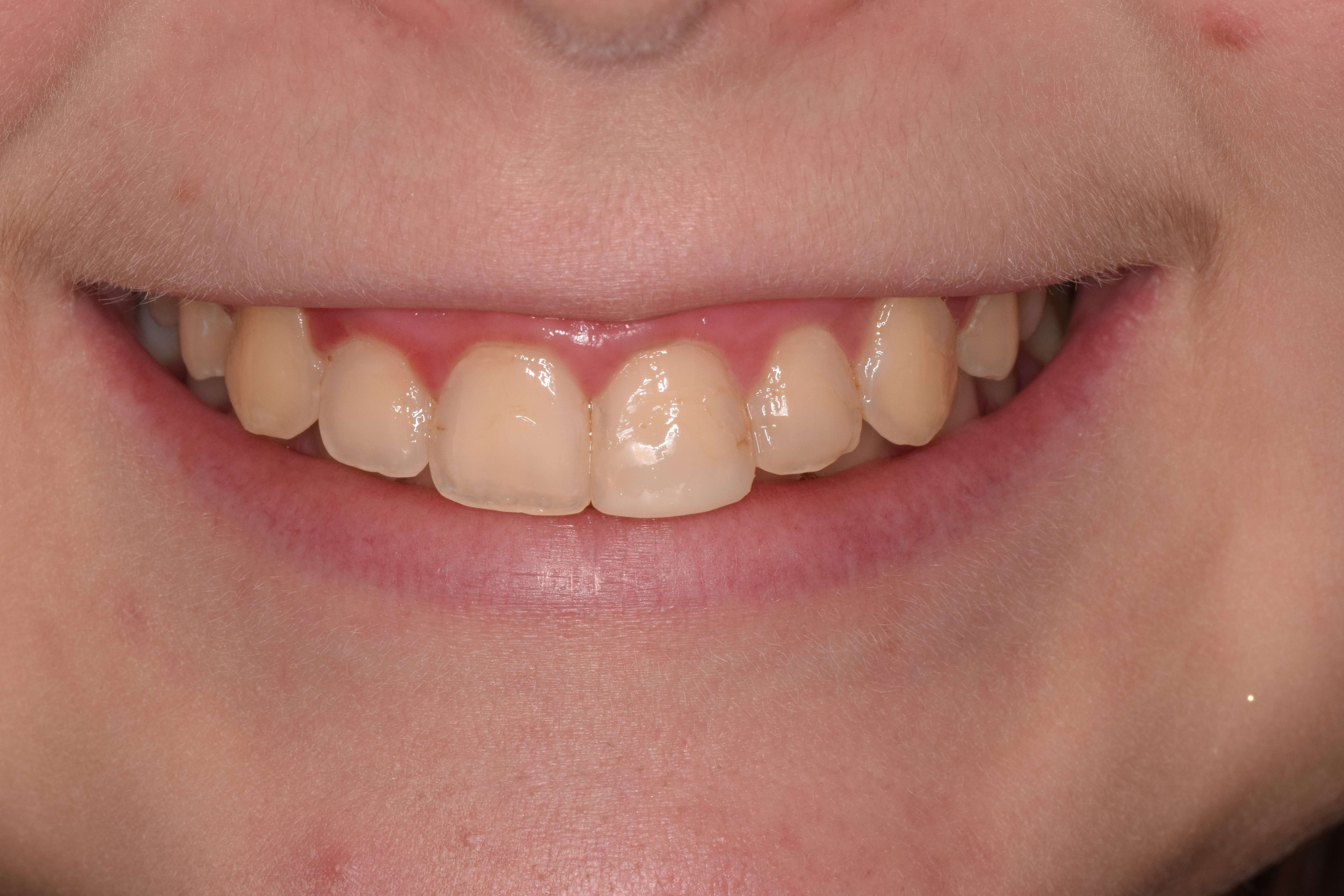 Before and After Composite Bonding & Smile Makeover Photos Before and After Composite Bonding & Smile Makeover Photos