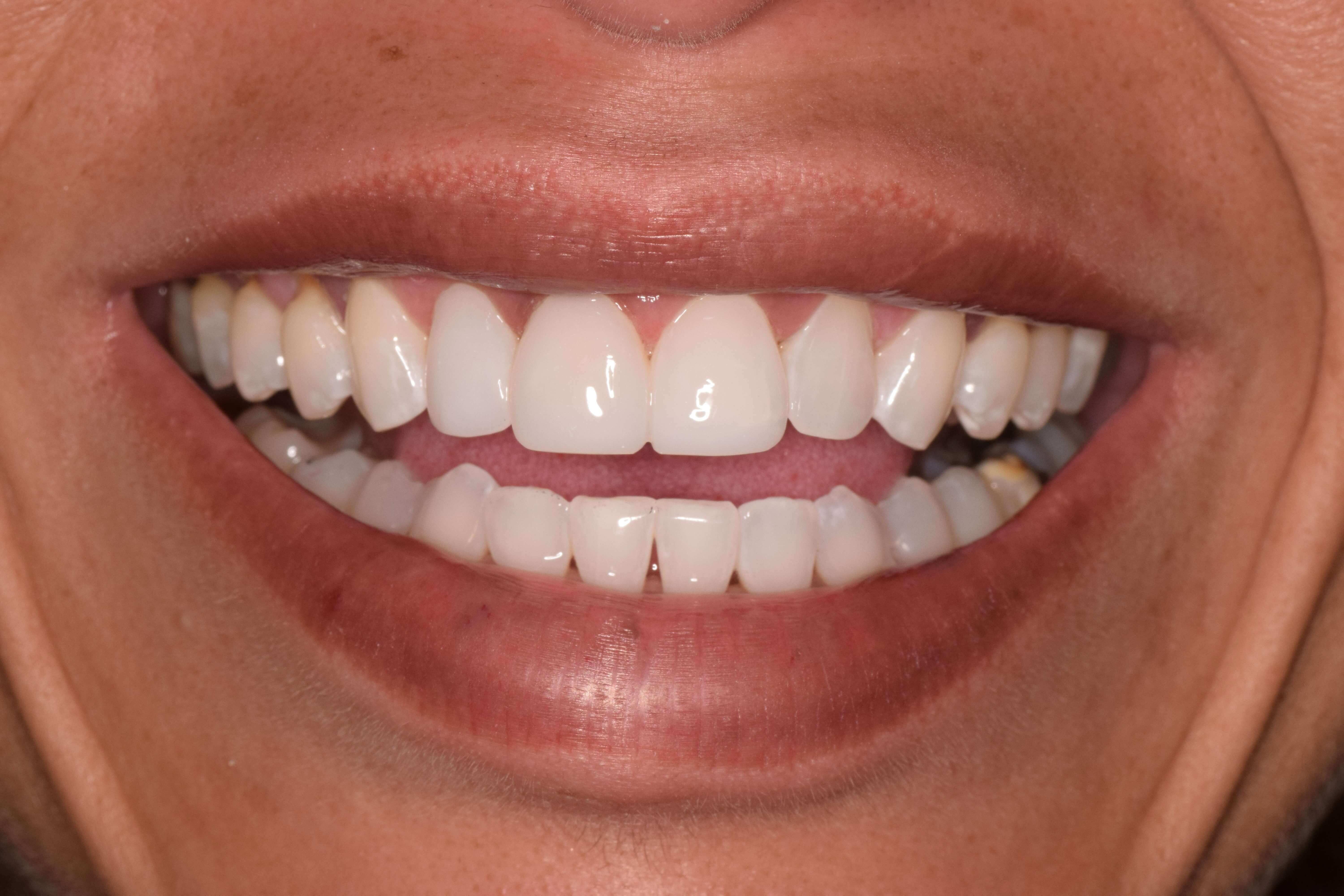Cosmetic Bonding After