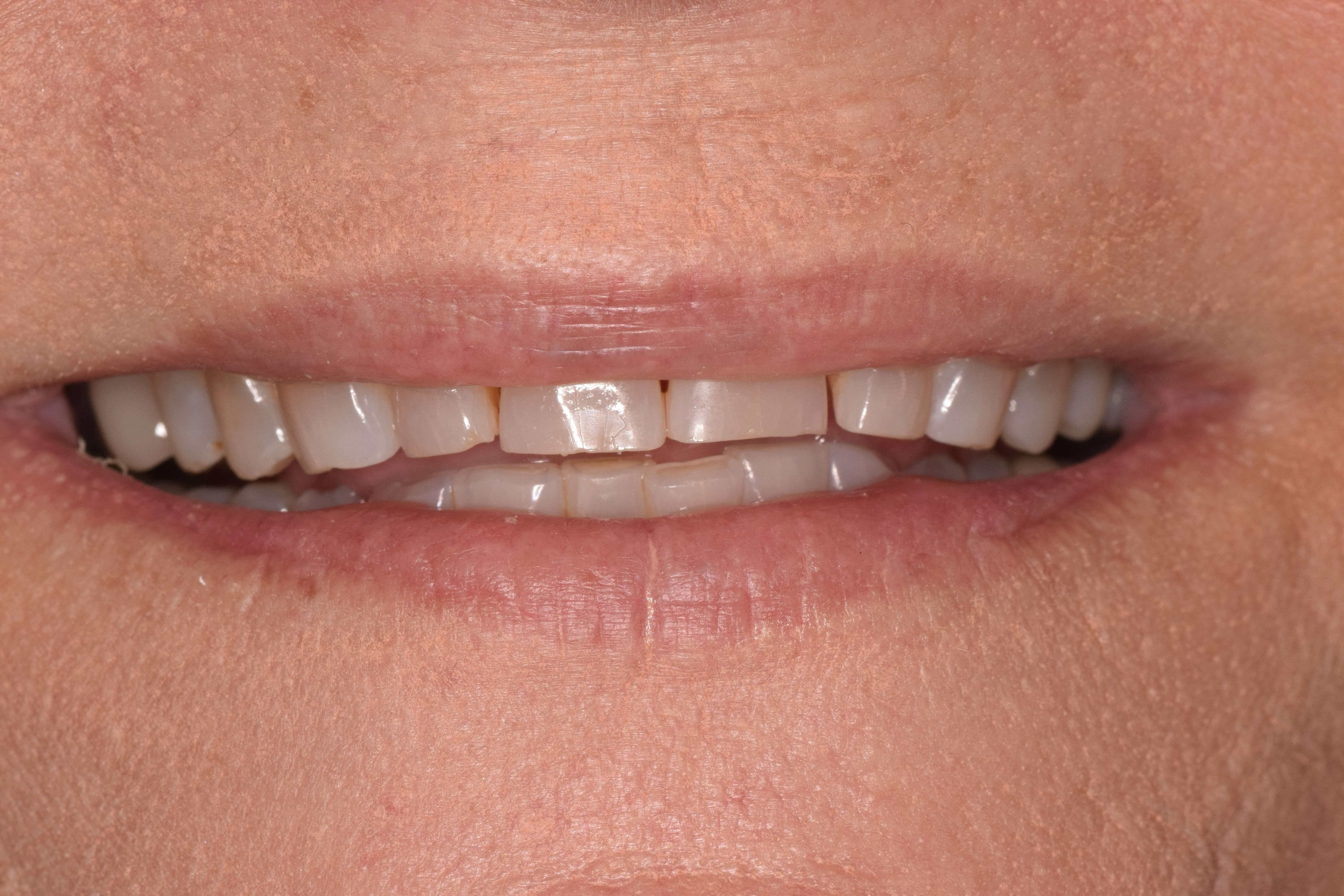 Cosmetic Bonding Before