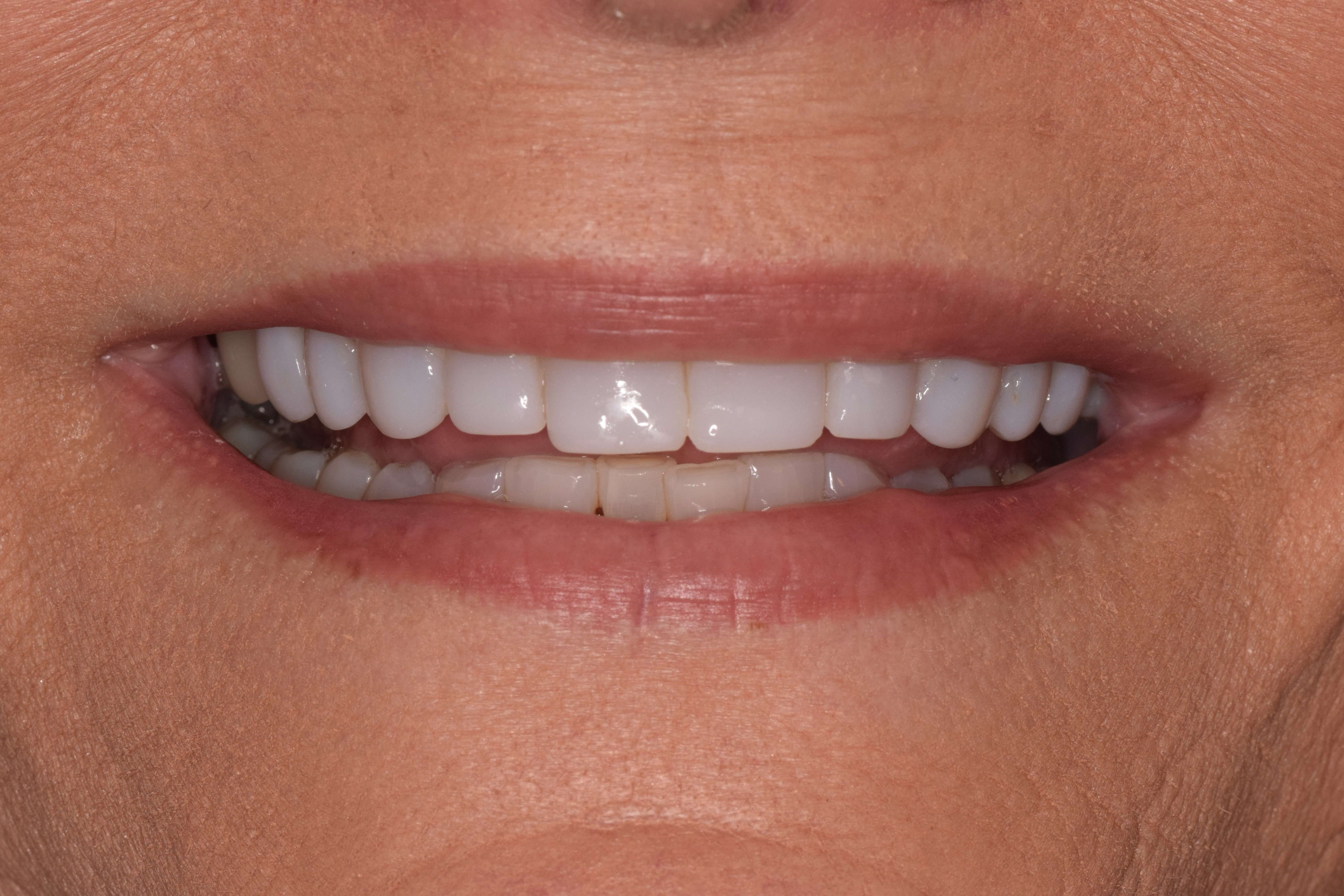 Cosmetic Bonding After