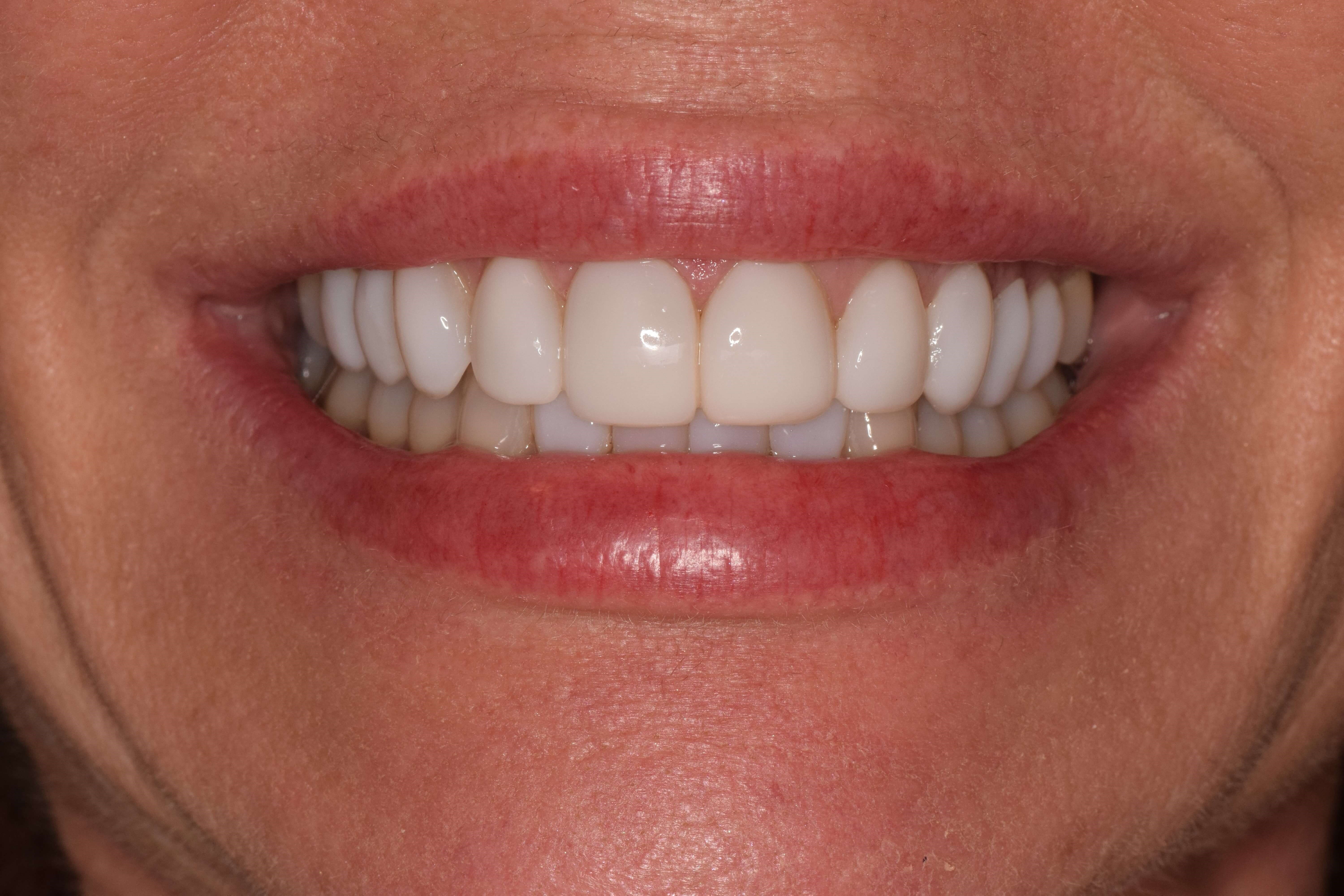 Cosmetic Bonding After
