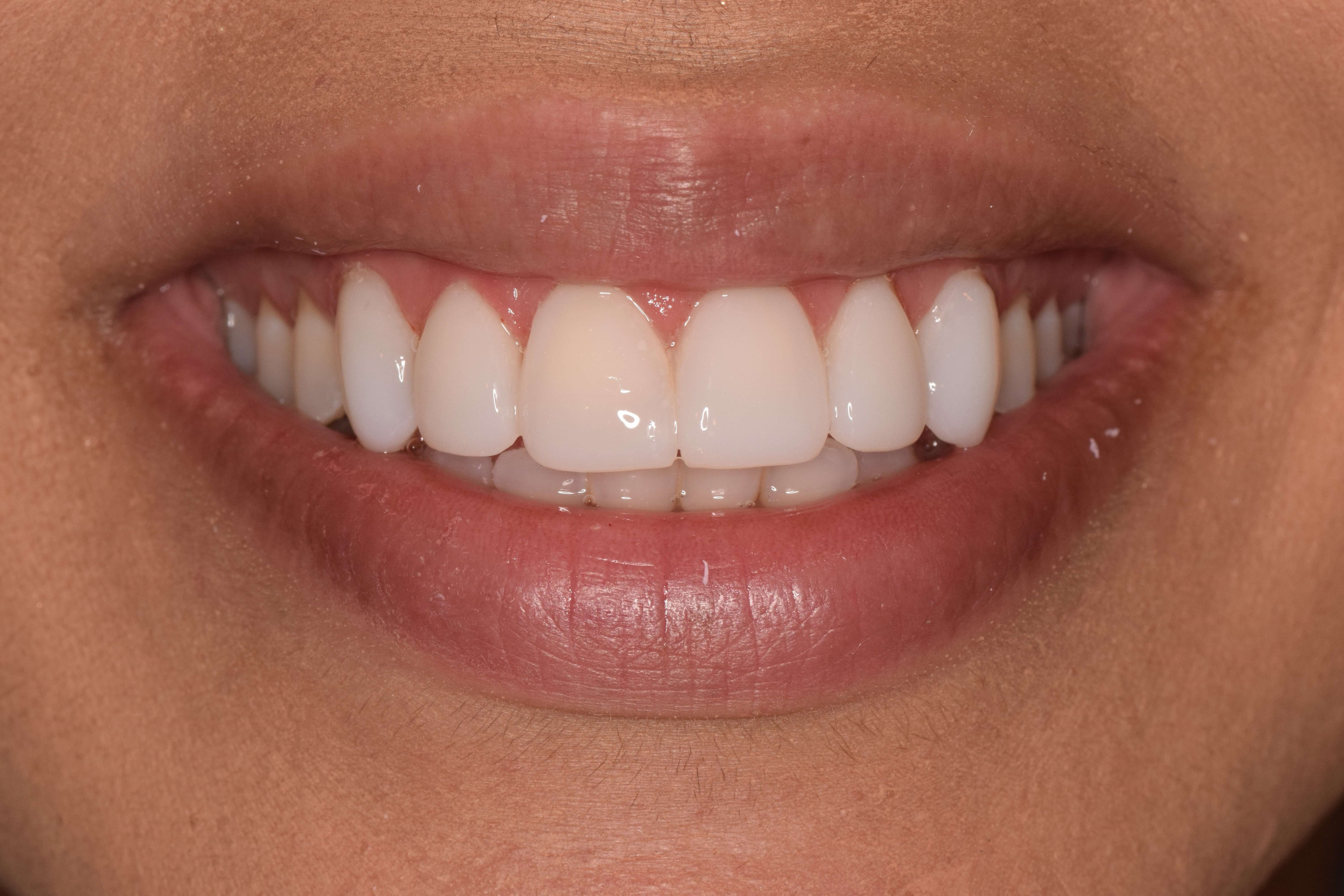 Cosmetic Bonding After