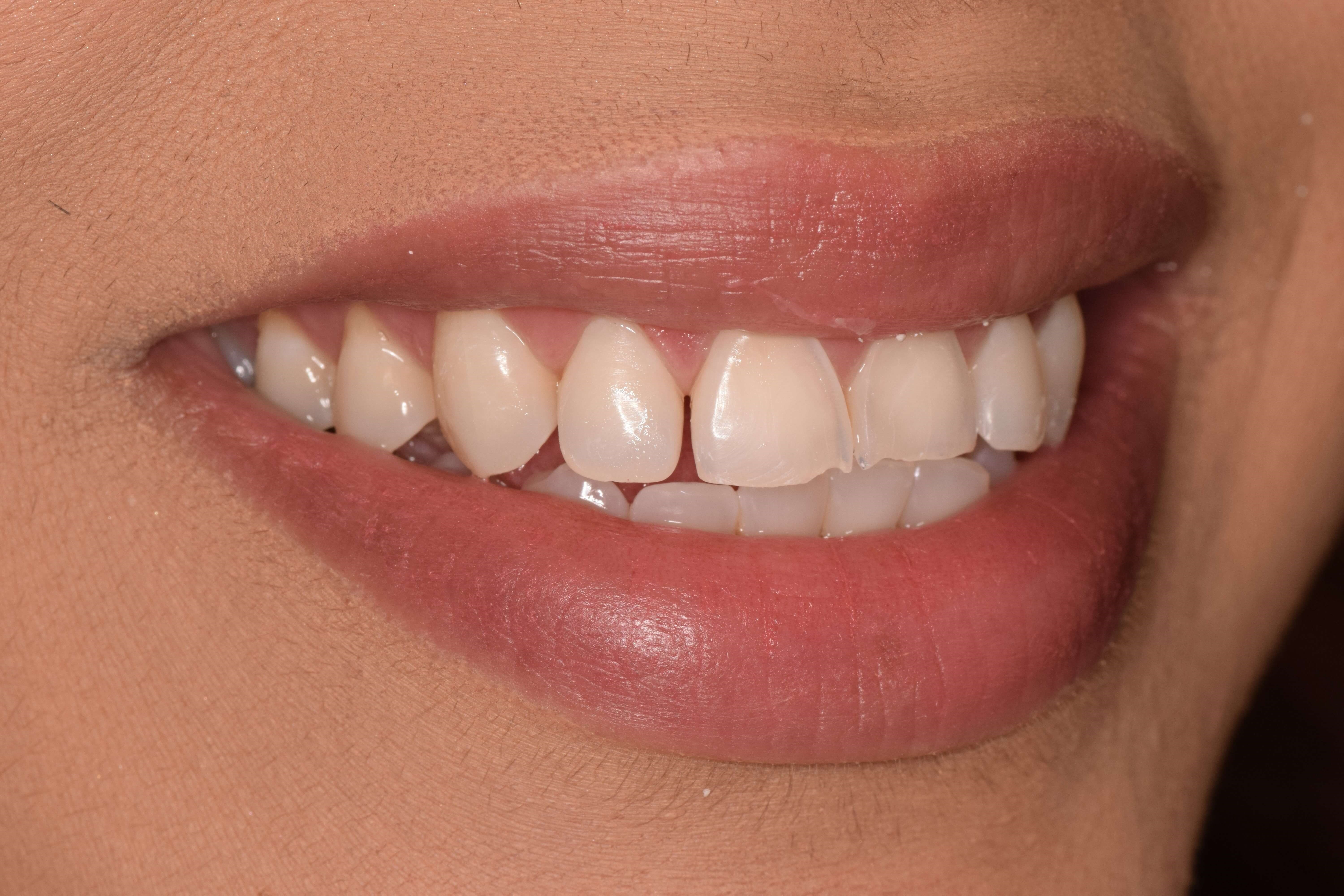 Cosmetic Bonding Before