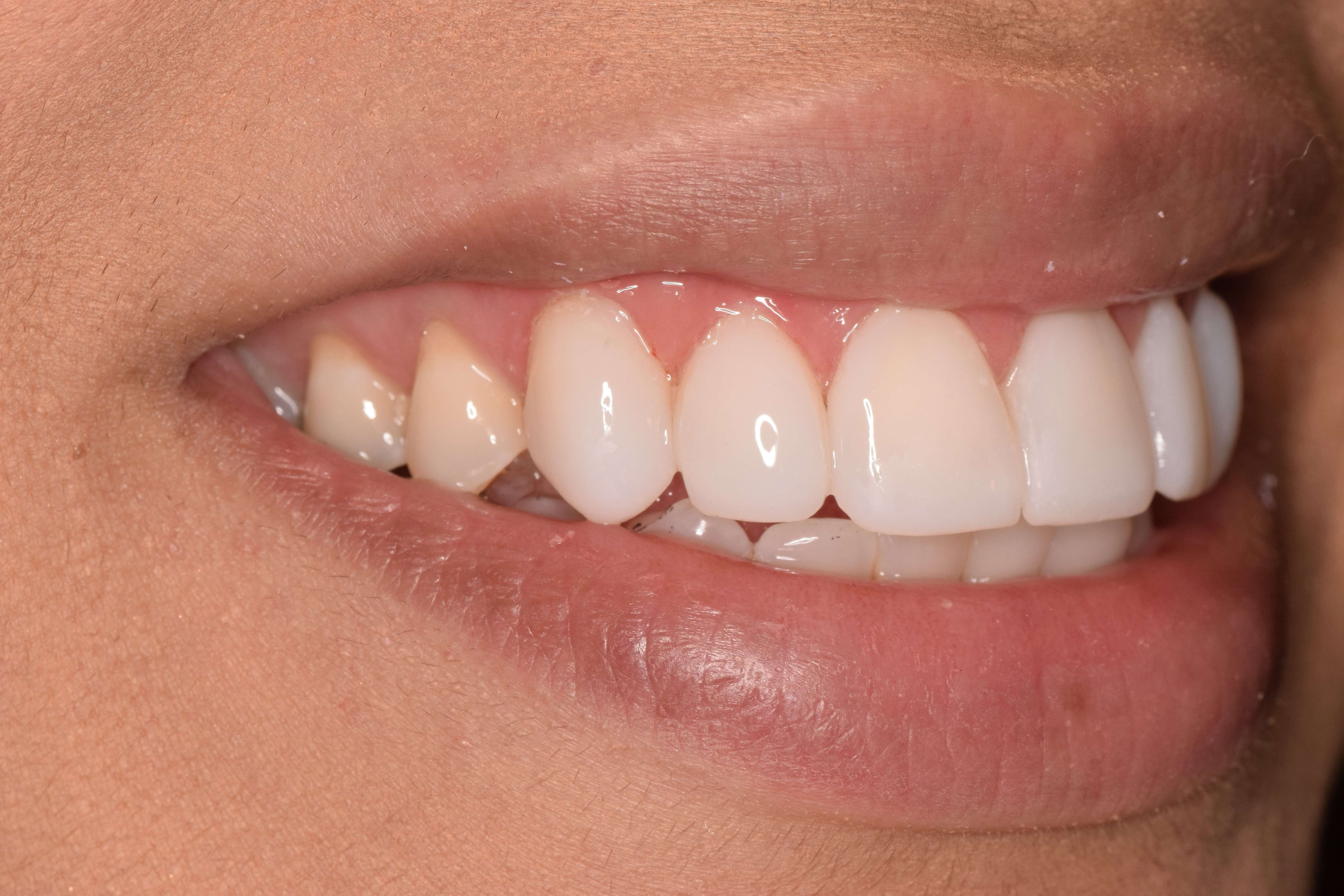 Cosmetic Bonding After