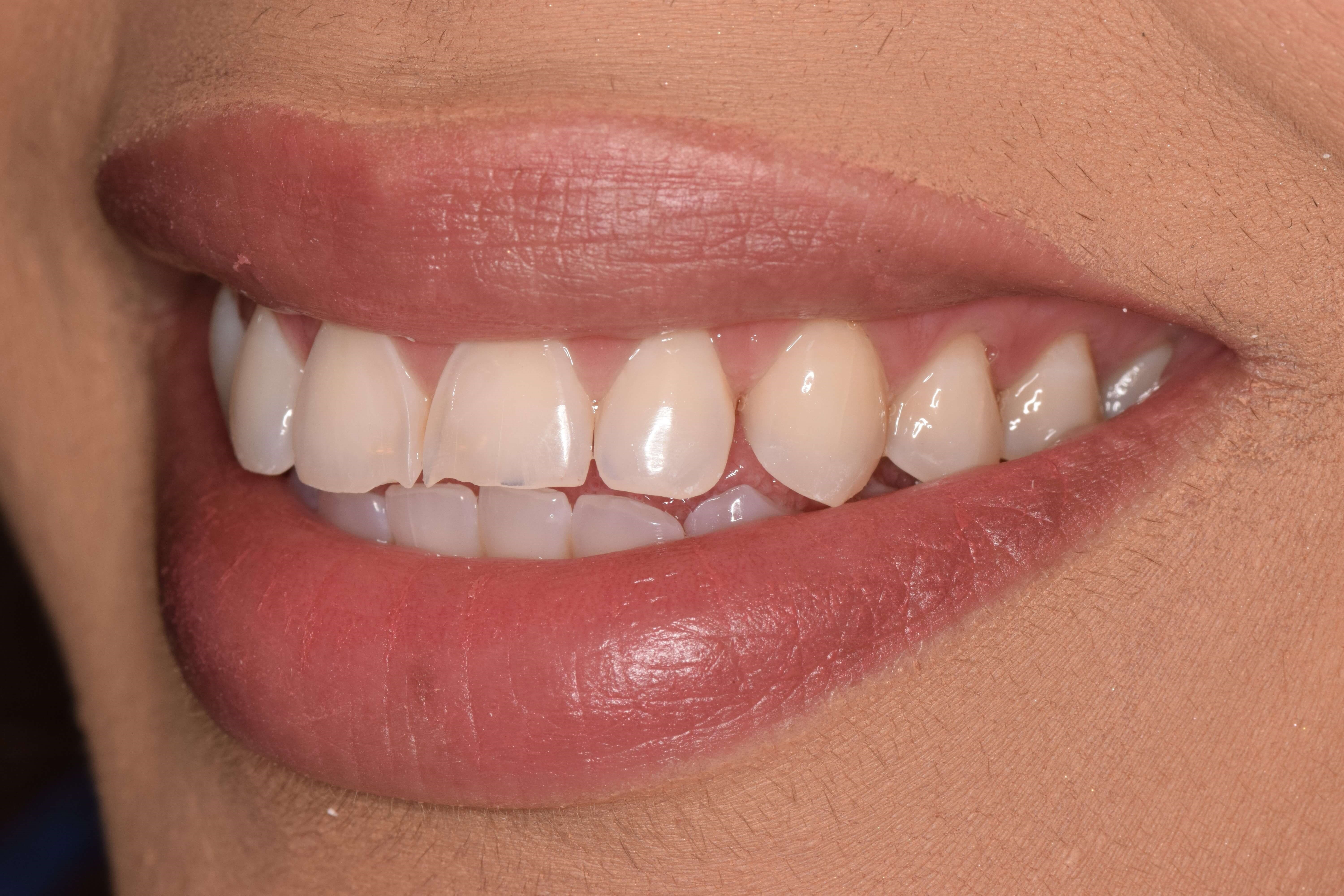 Cosmetic Bonding Before