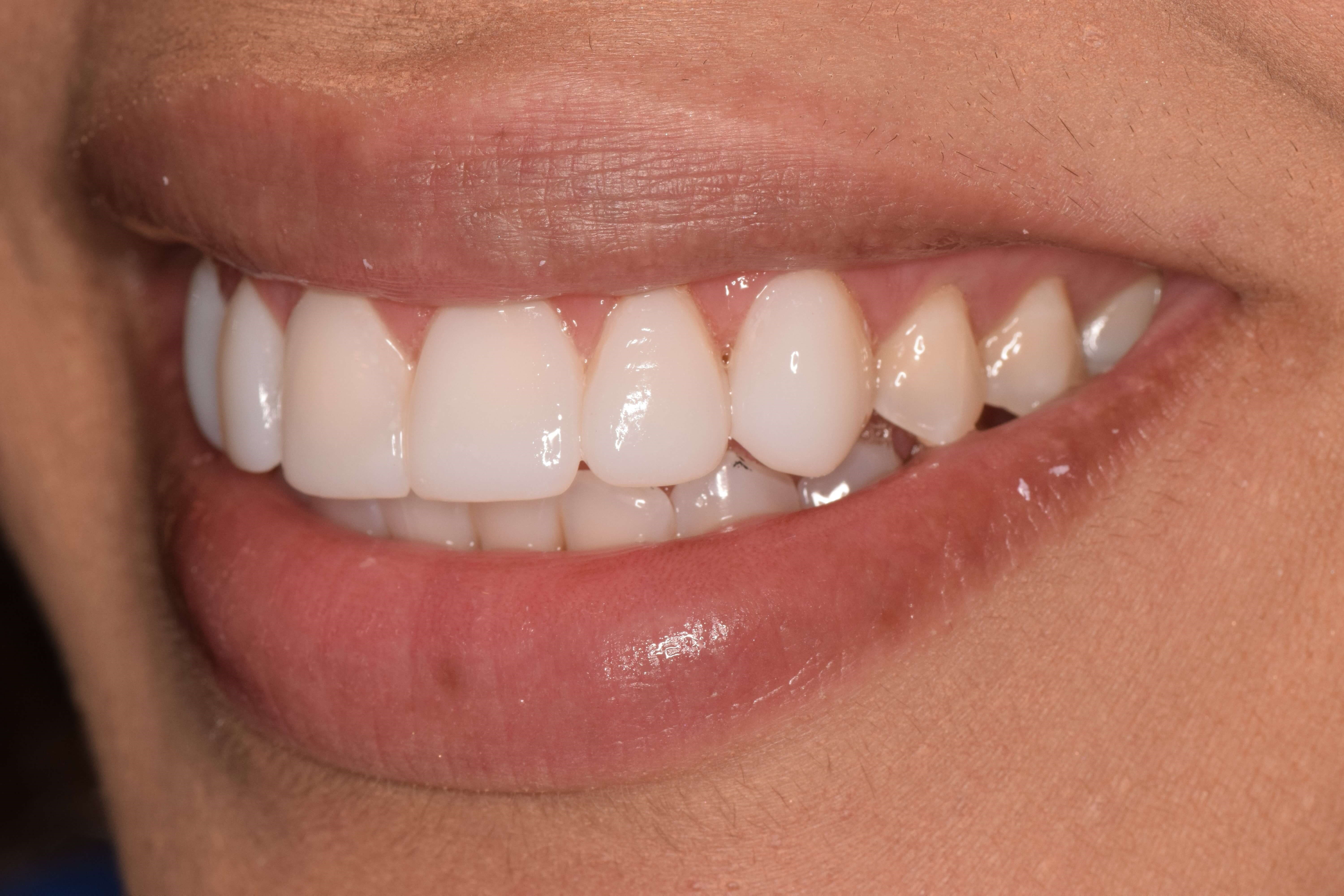 Cosmetic Bonding After