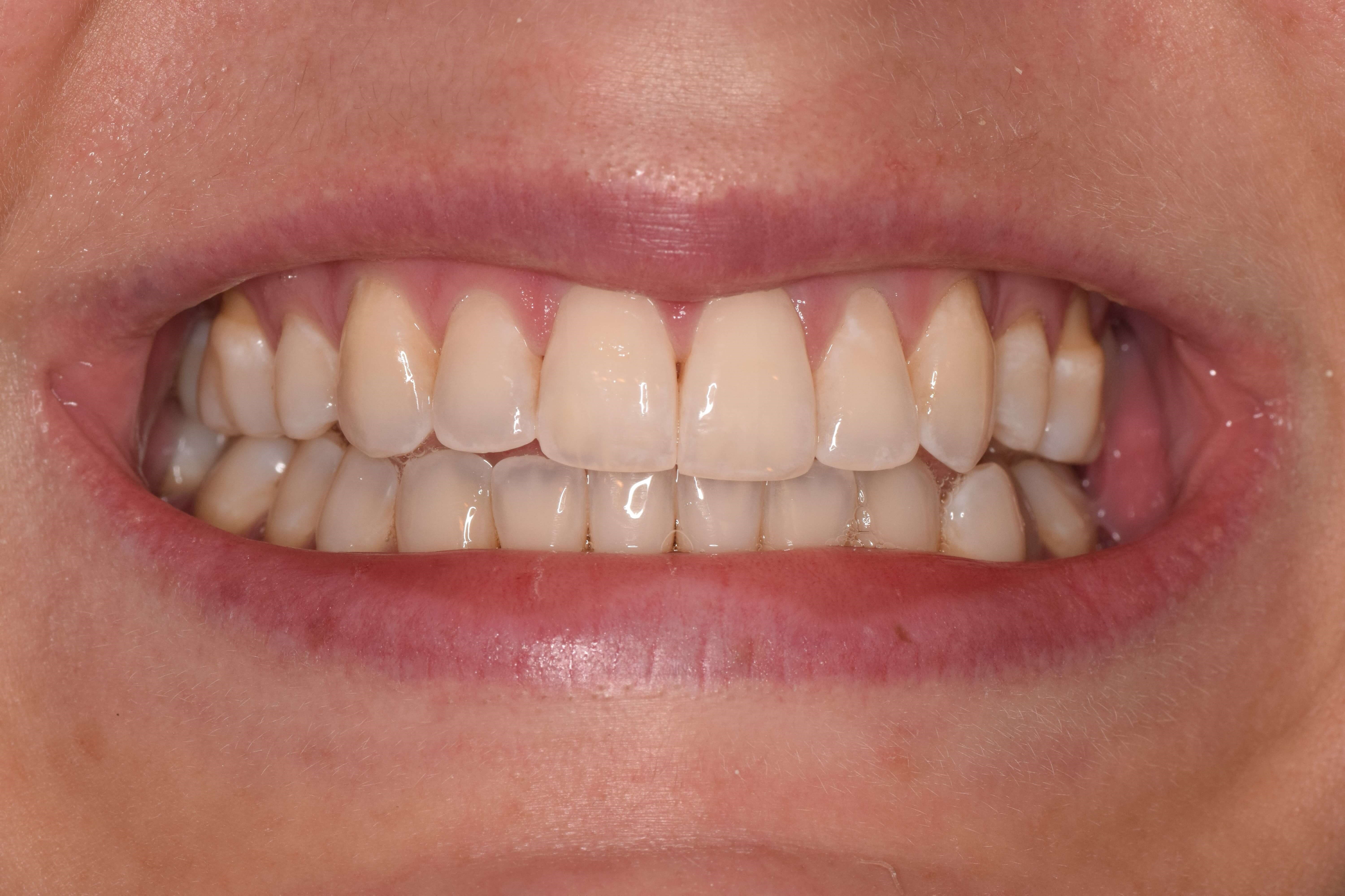 White Spot Removal After