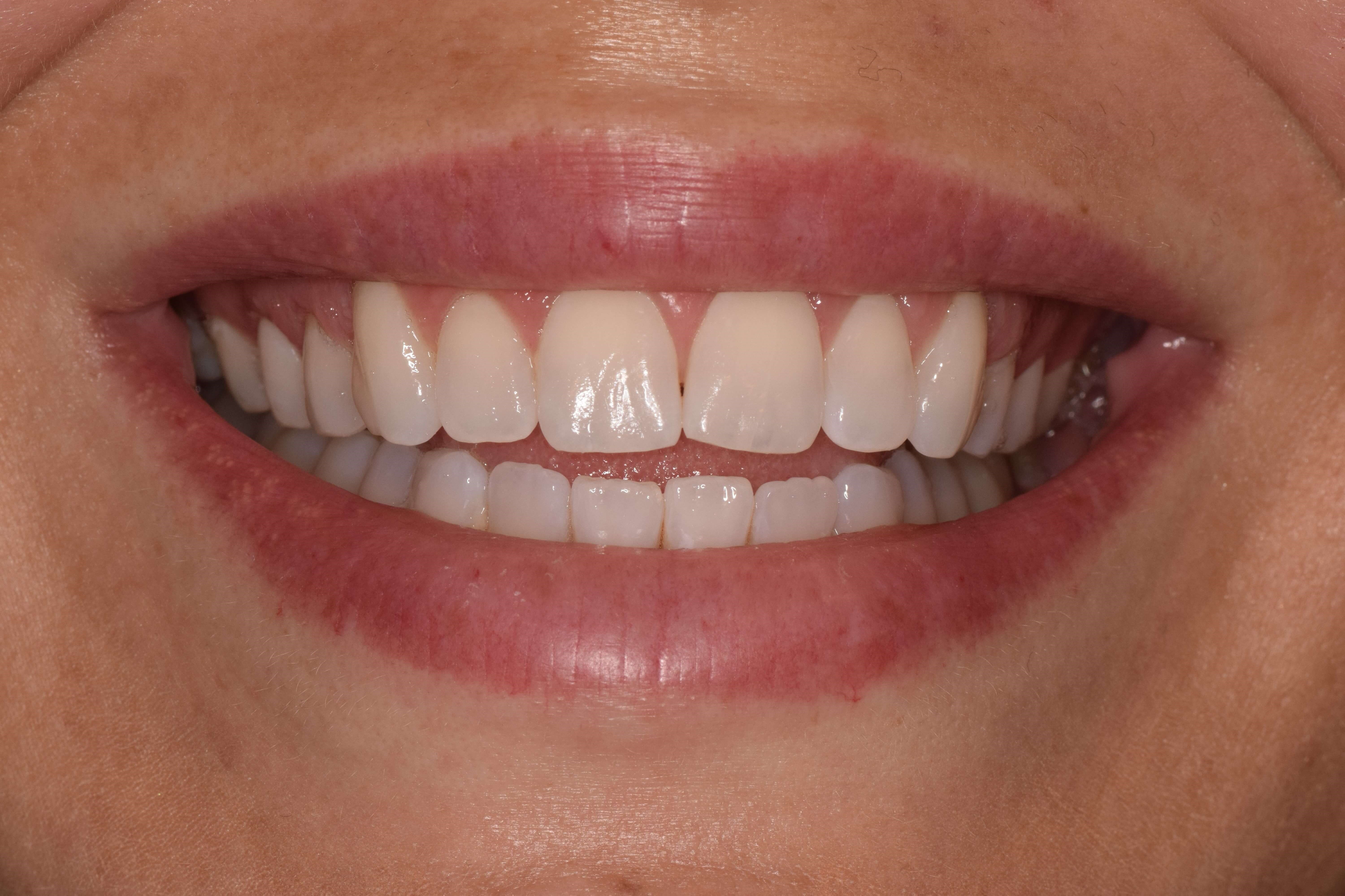 Cosmetic Bonding Before