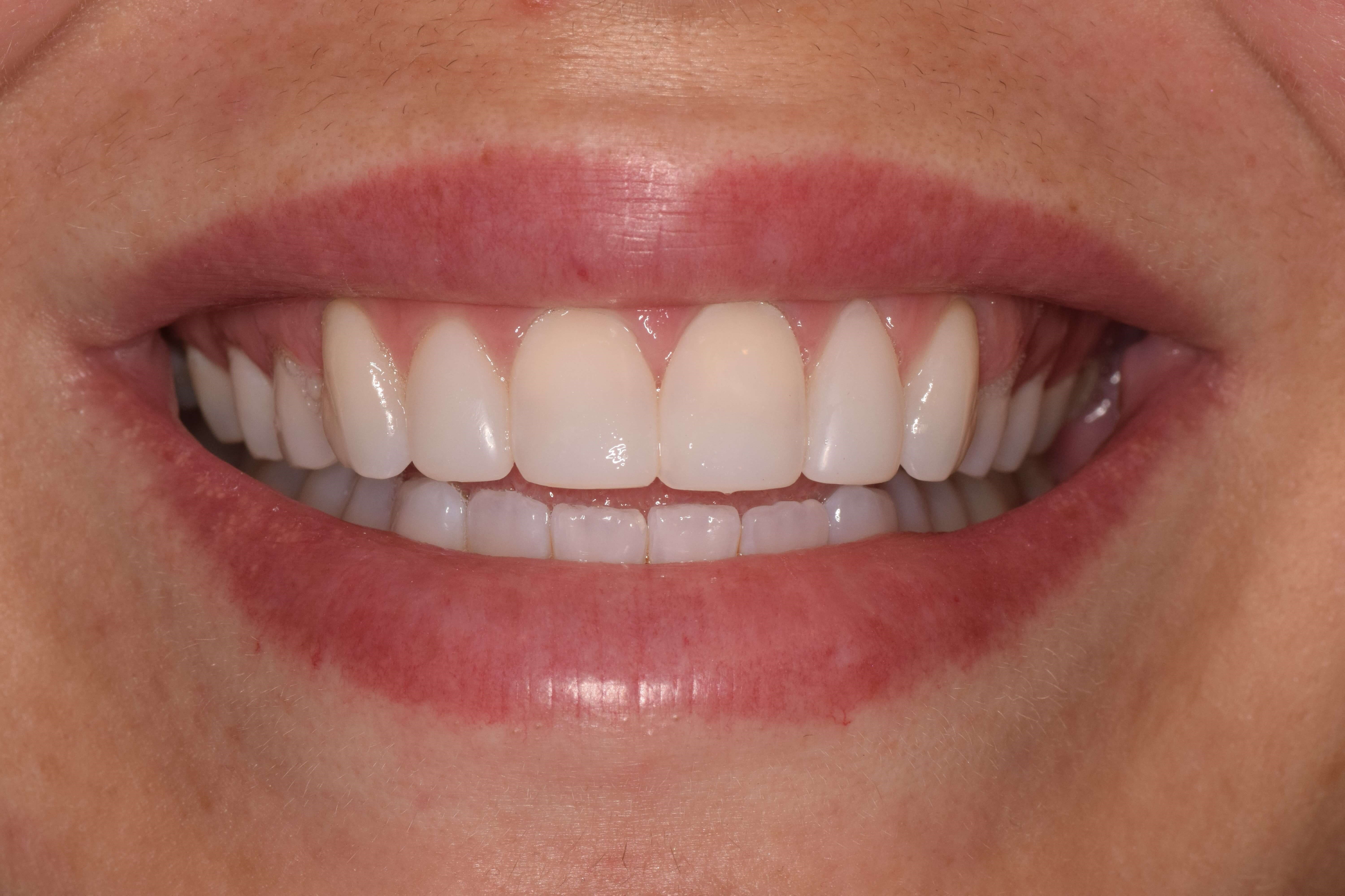 Cosmetic Bonding After