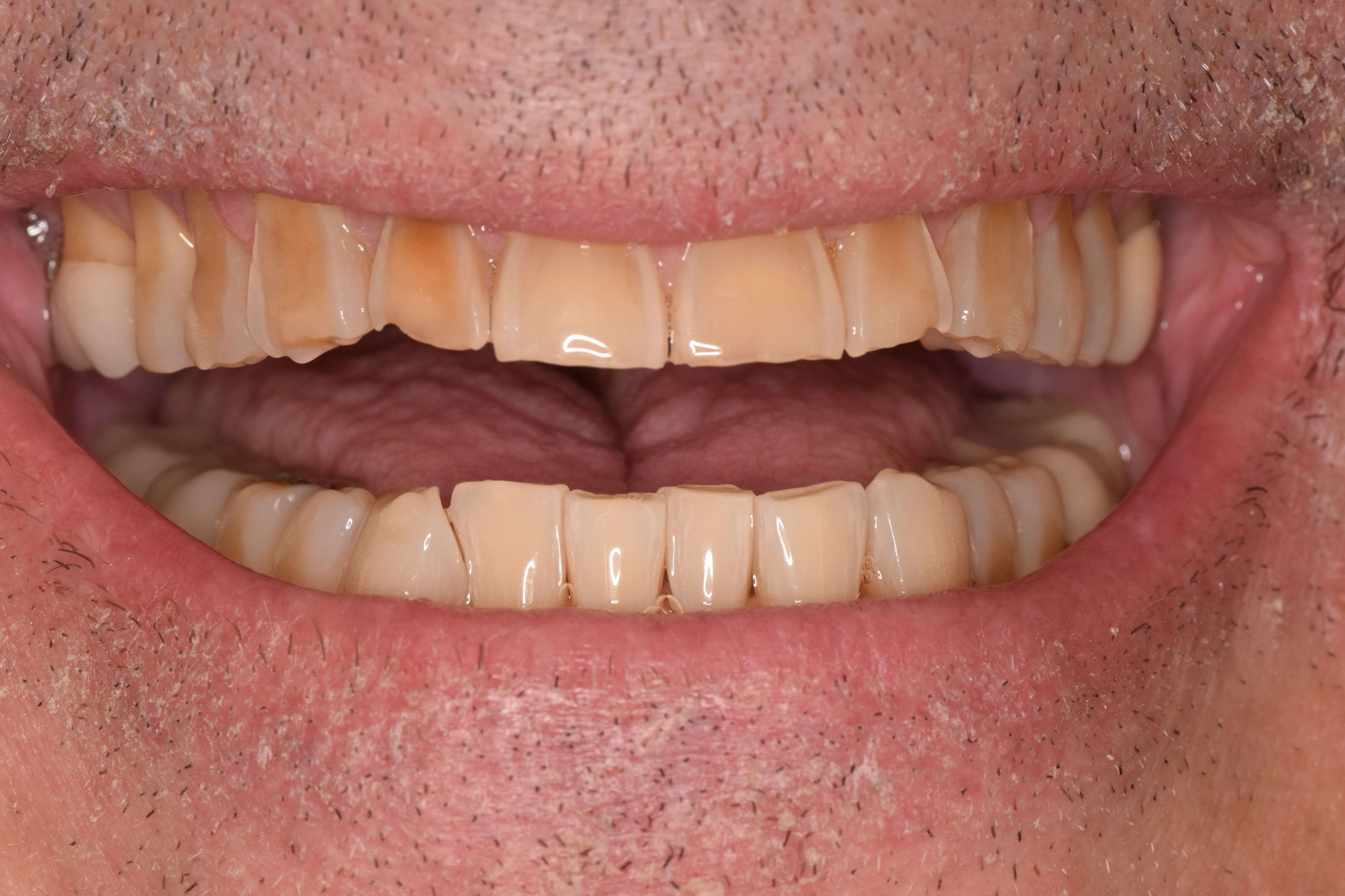 Cosmetic Bonding Before