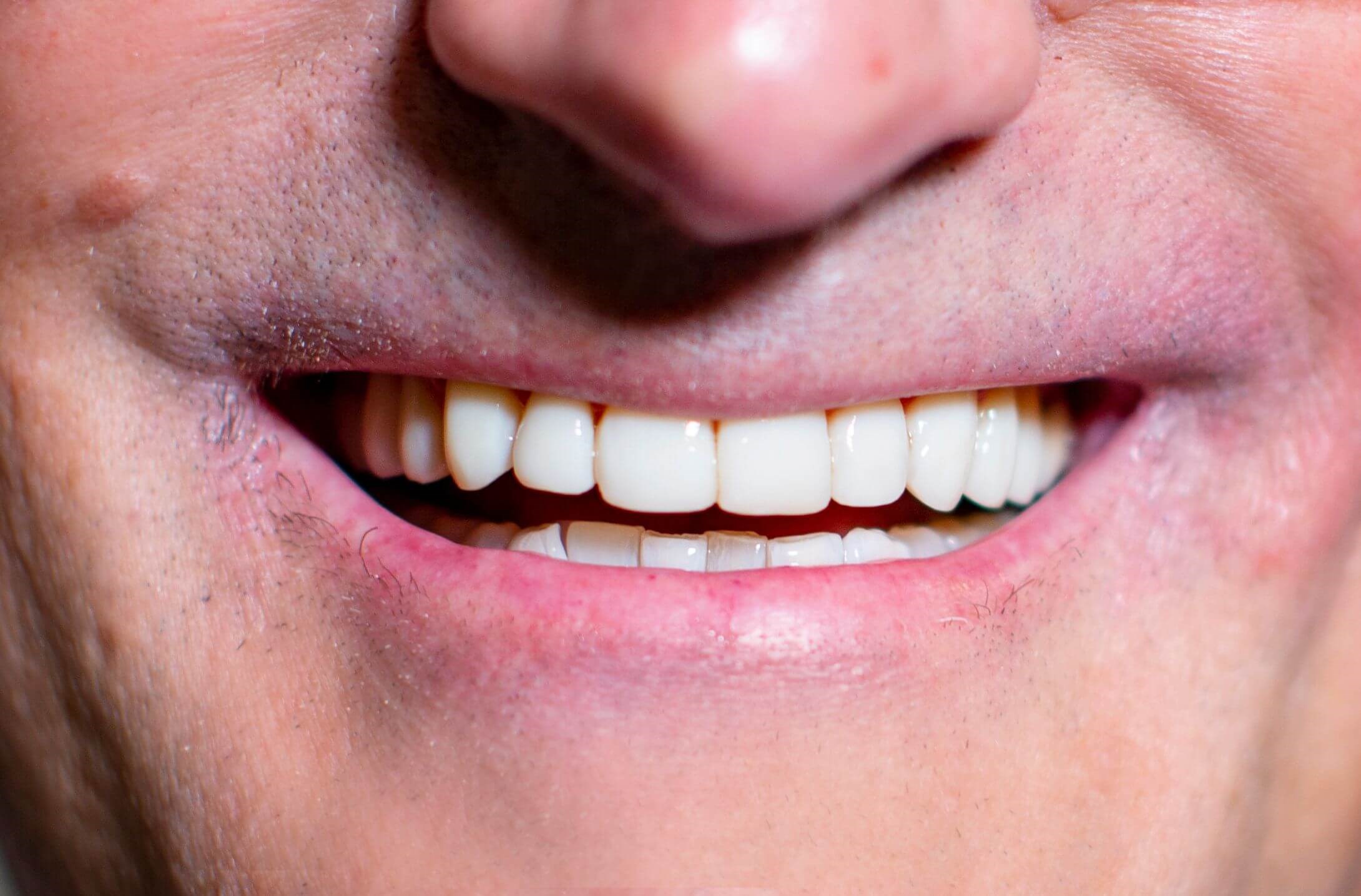 Cosmetic Bonding After