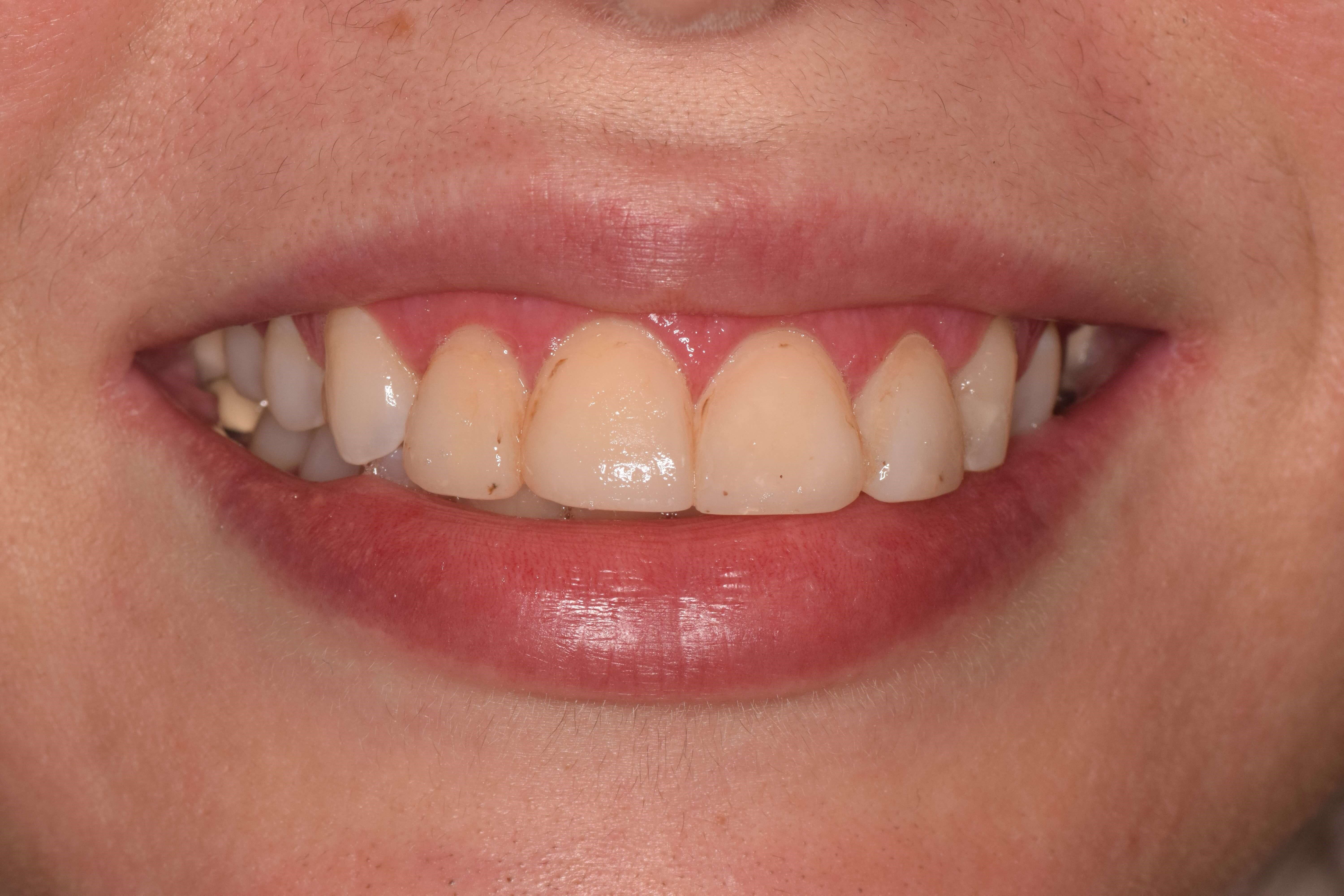 Cosmetic Bonding Before