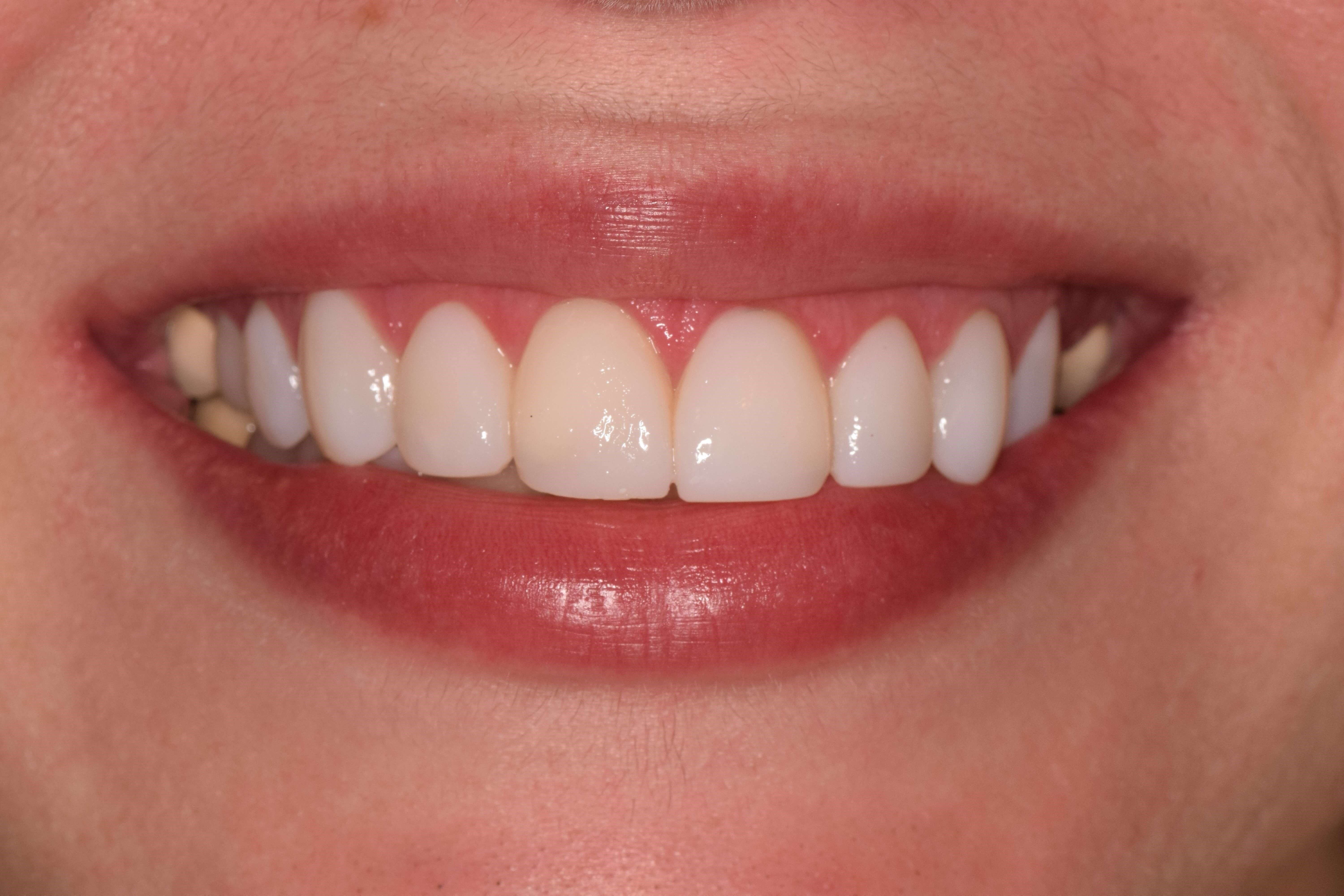 Cosmetic Bonding After