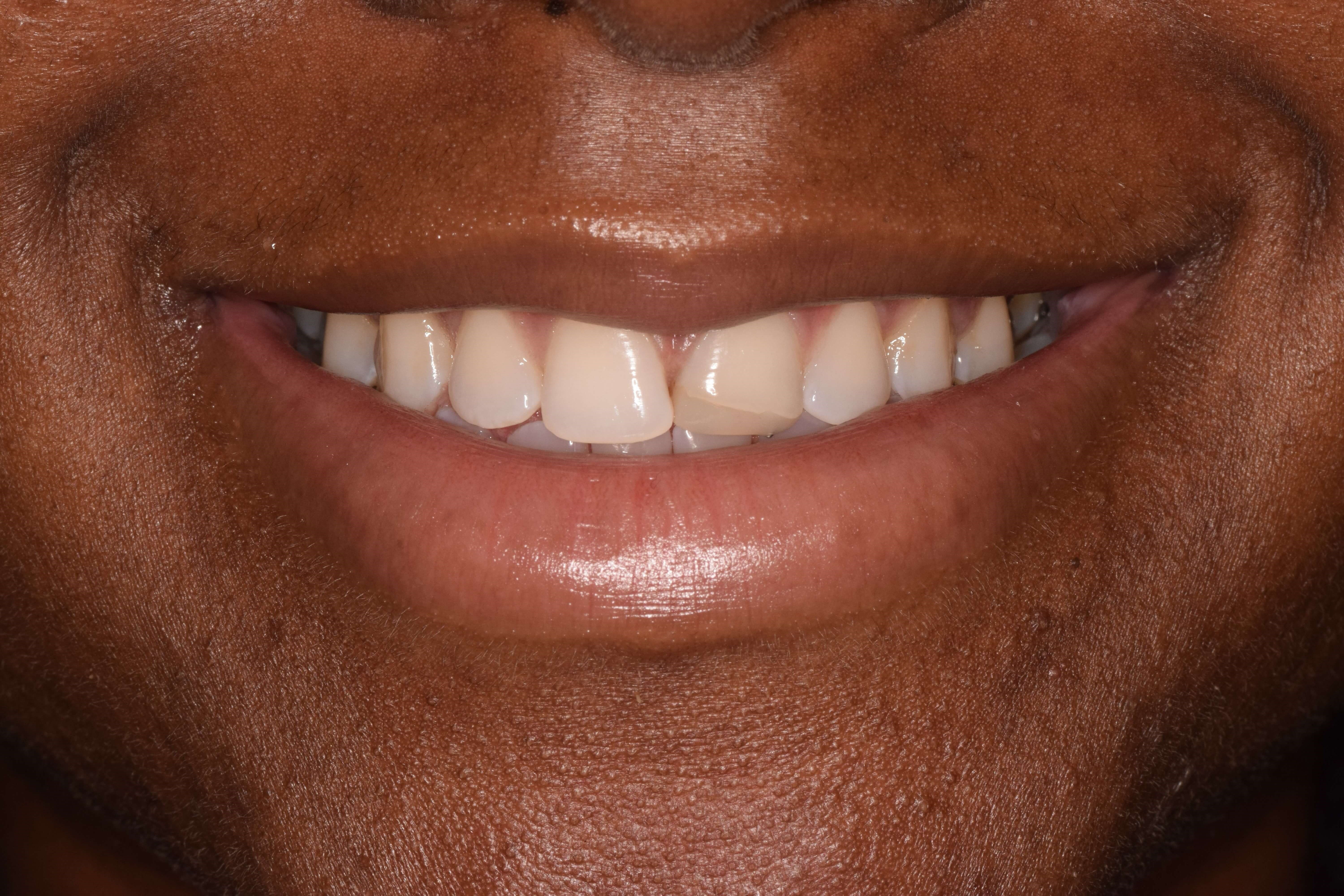 Cosmetic Bonding Before