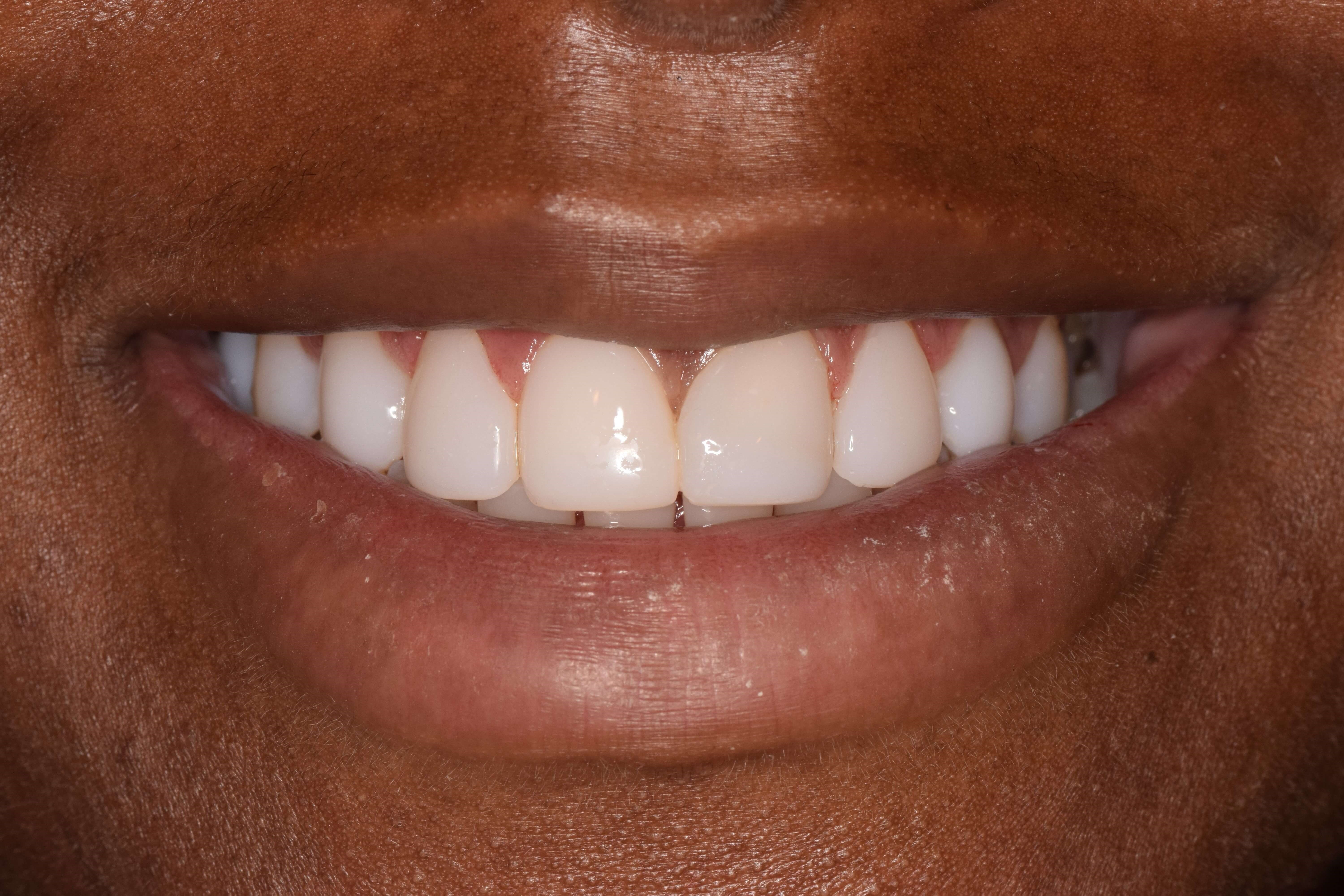 Cosmetic Bonding After