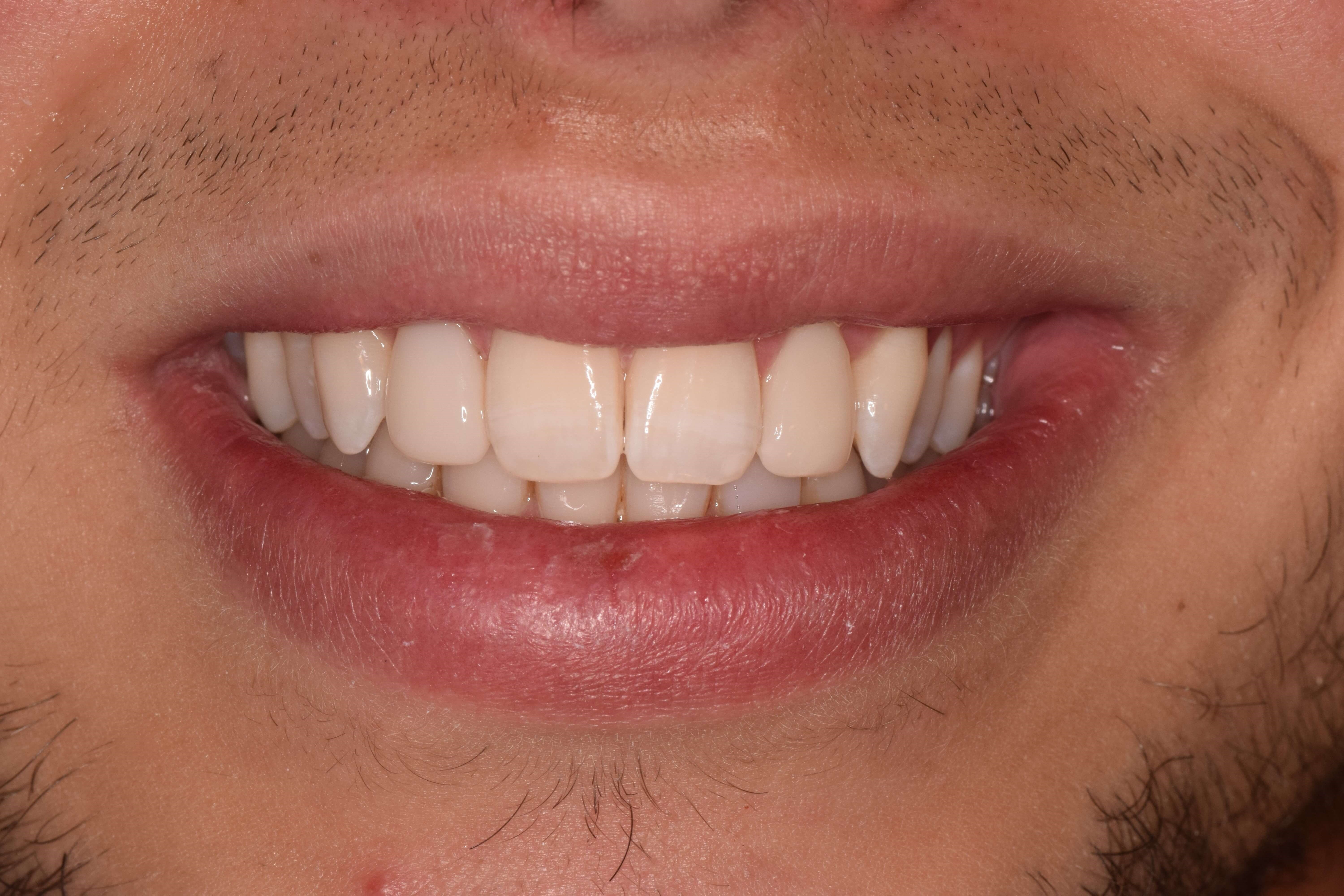 Cosmetic Bonding After