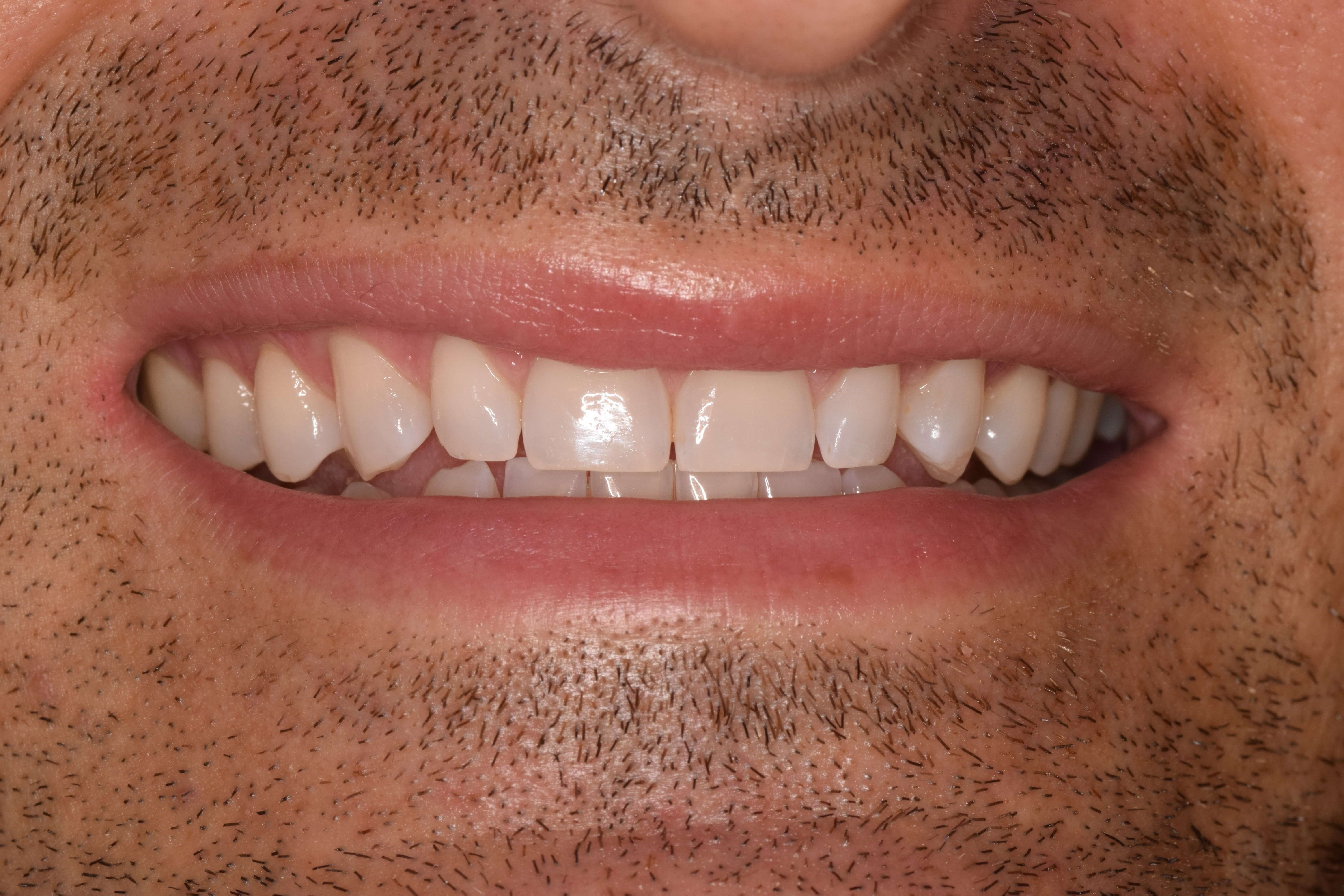 Cosmetic Bonding Before