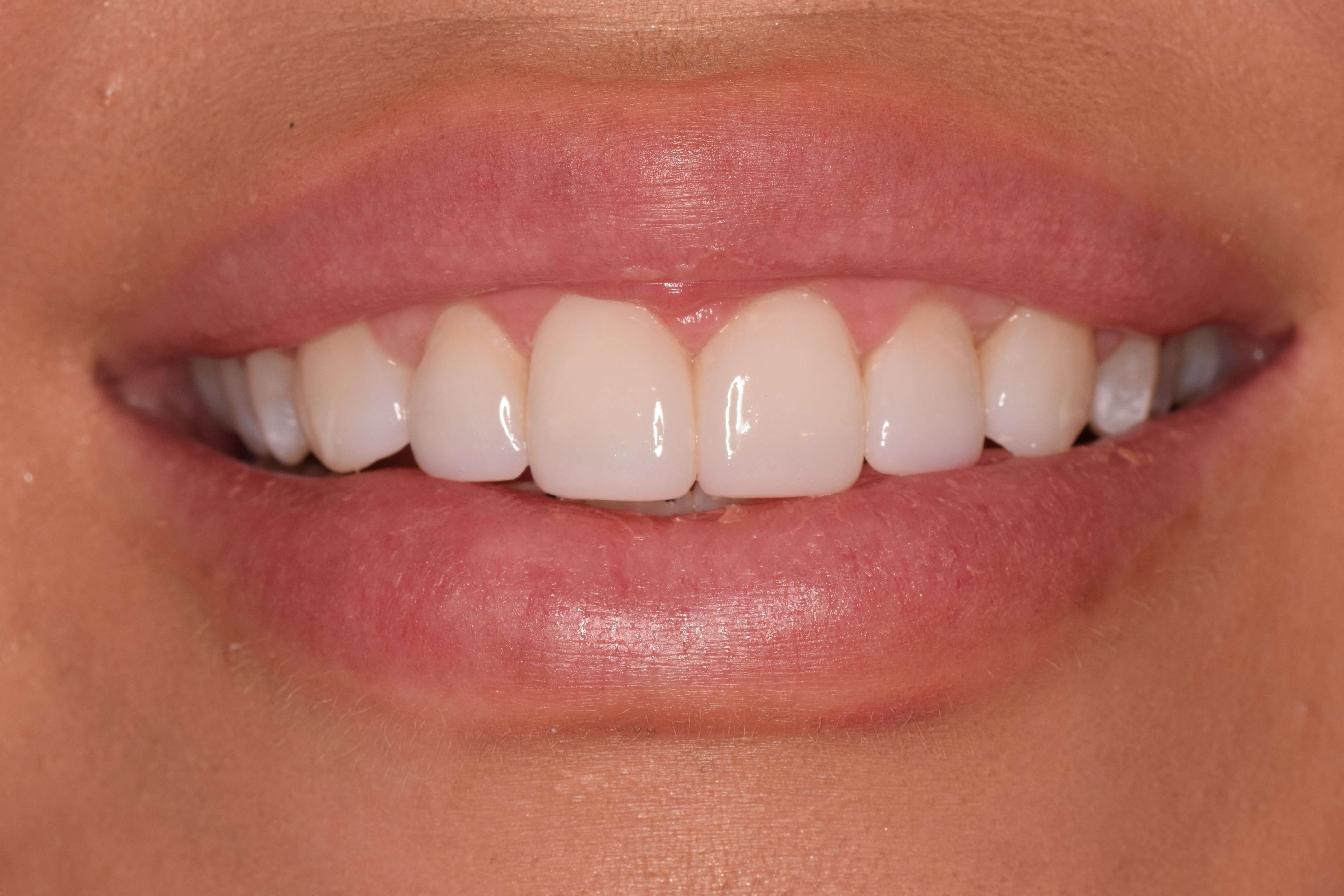 Cosmetic Bonding After