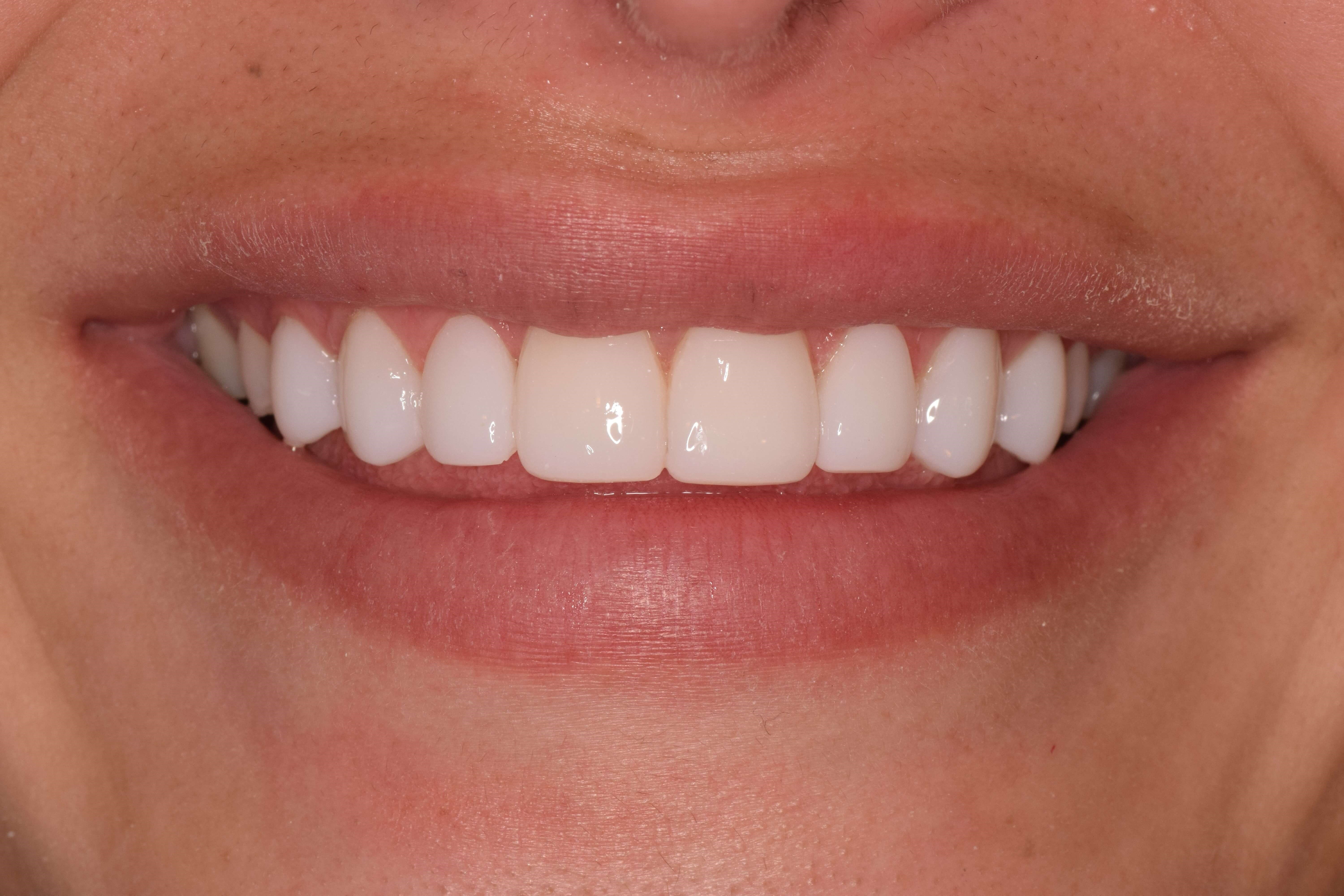 Cosmetic Bonding After