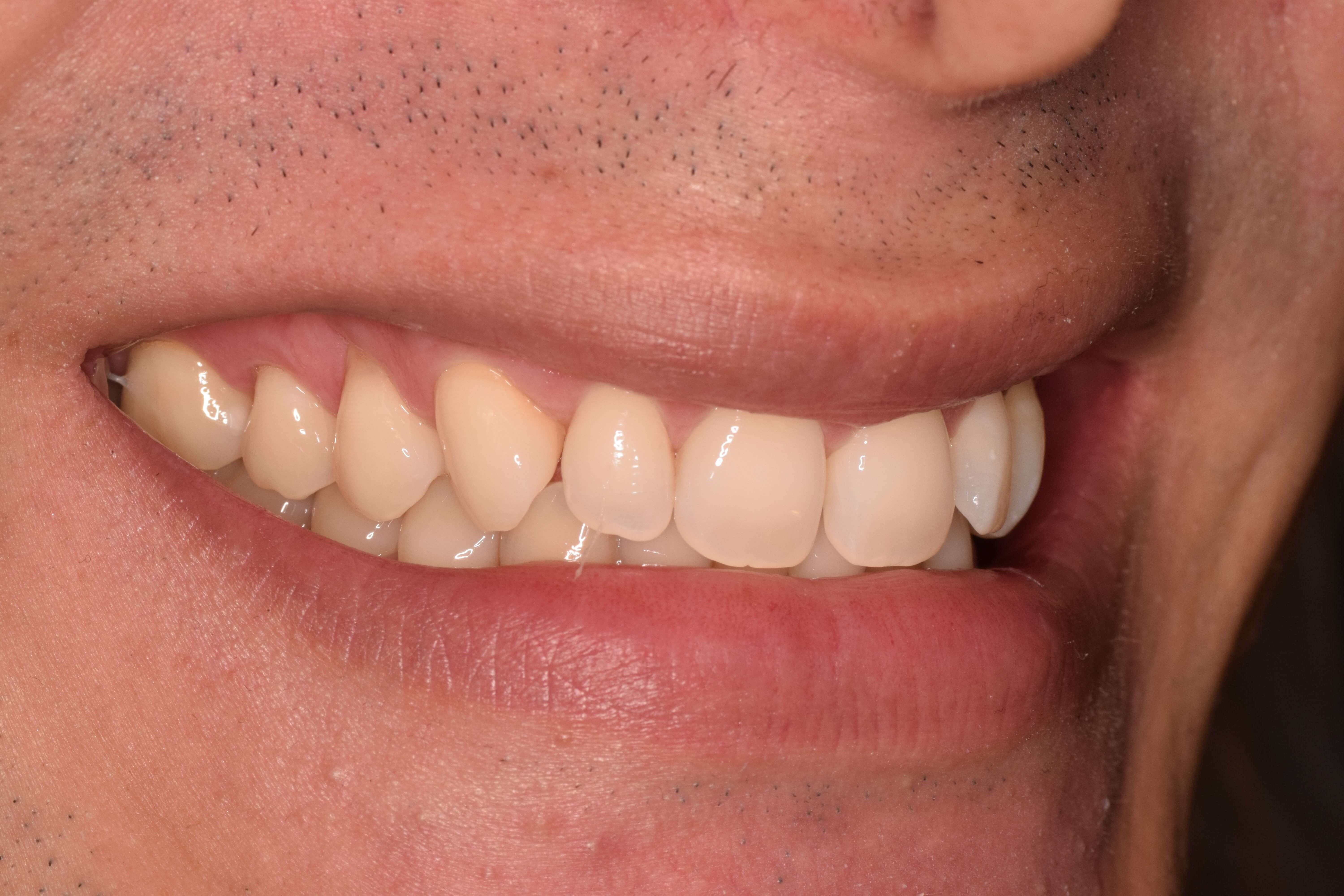 Cosmetic Bonding Before