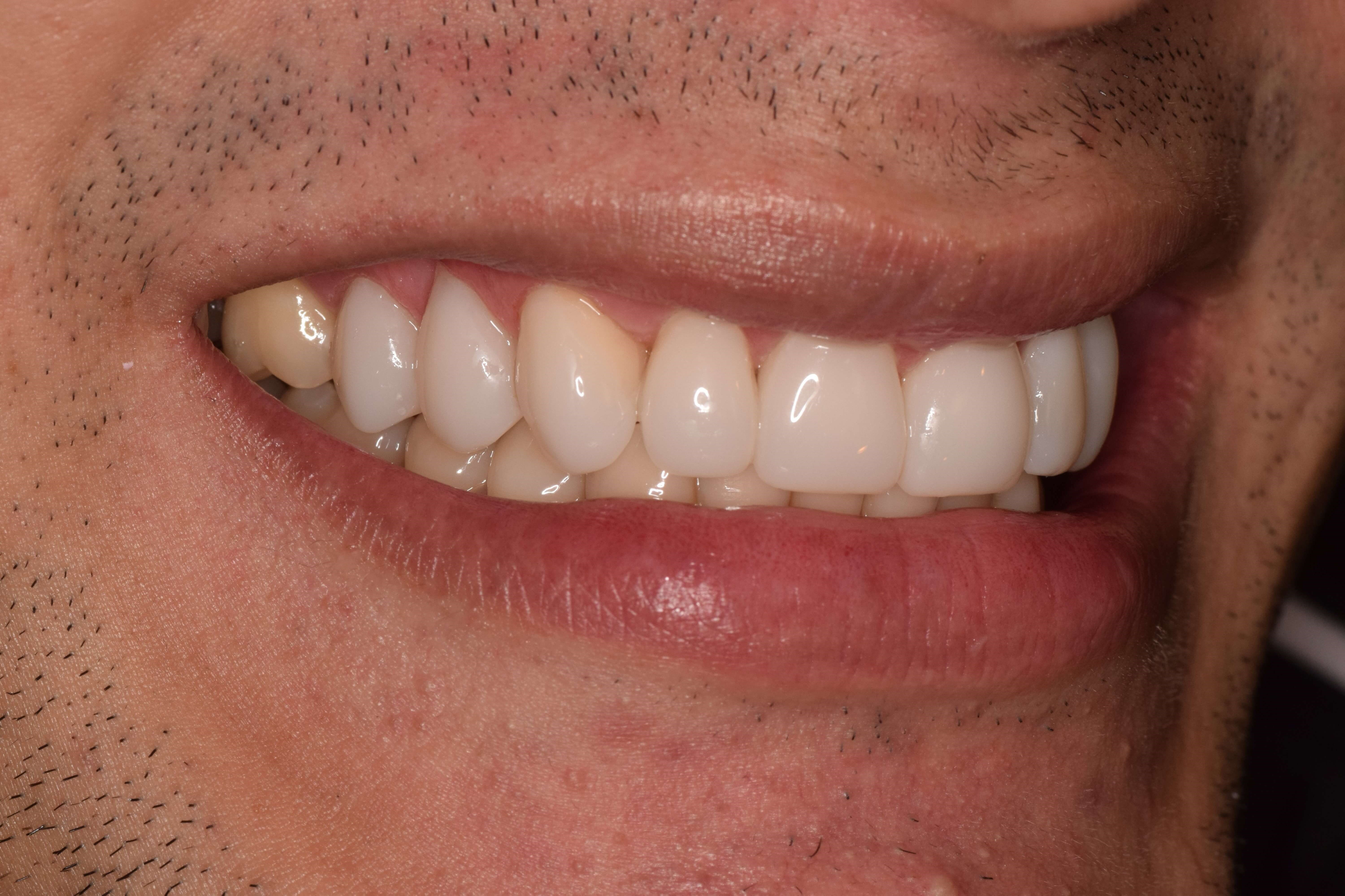 Cosmetic Bonding After