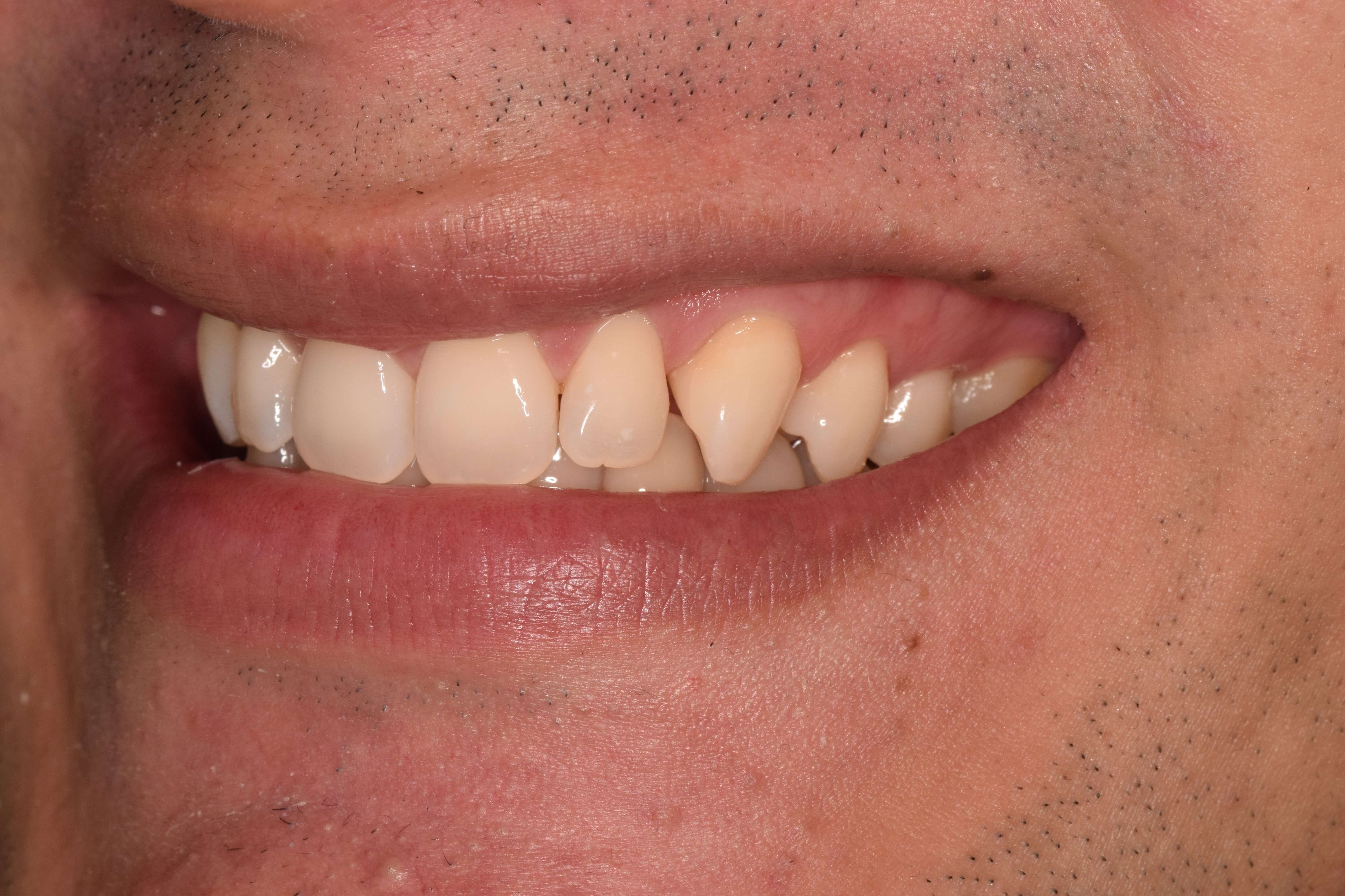 Cosmetic Bonding Before