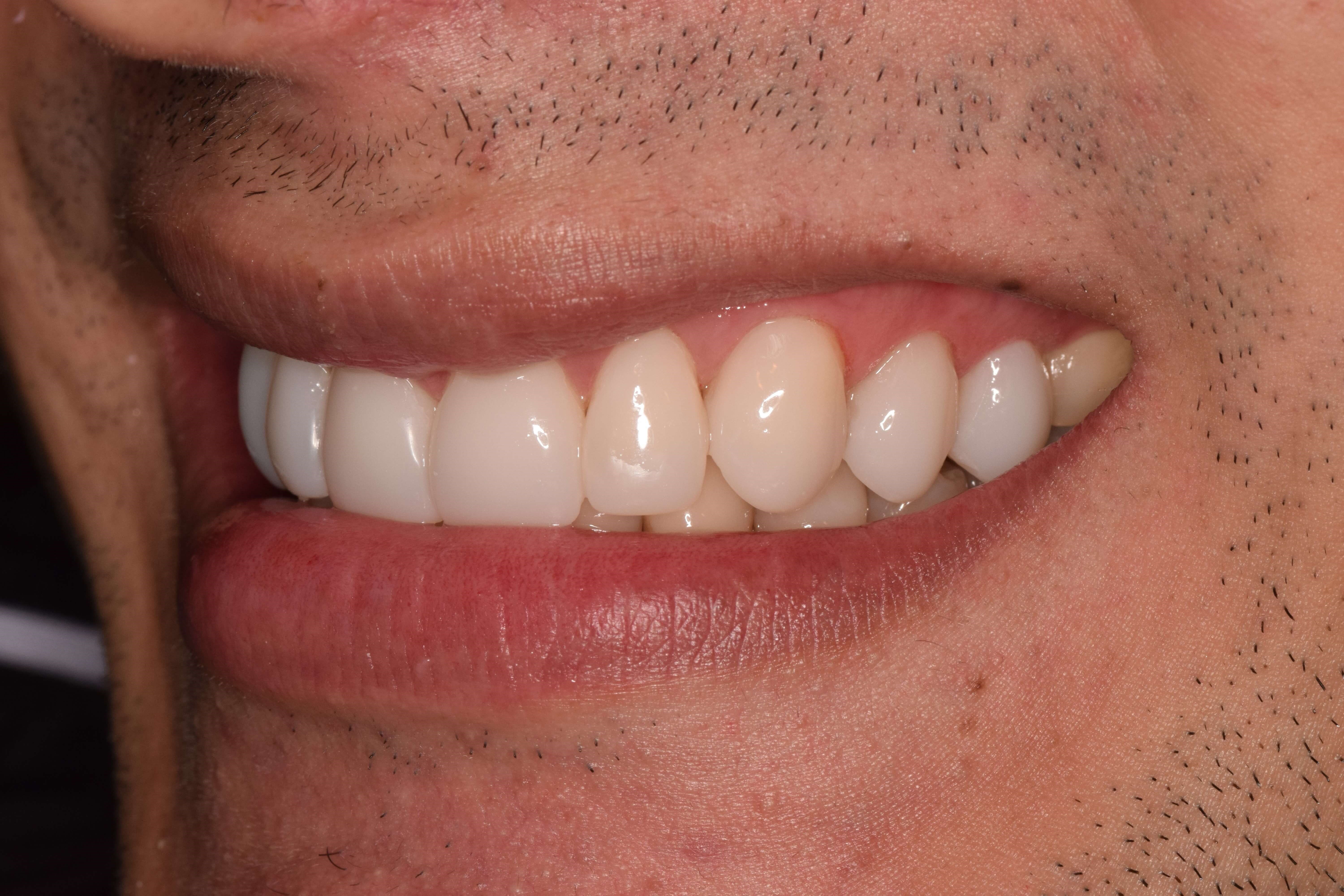 Cosmetic Bonding After