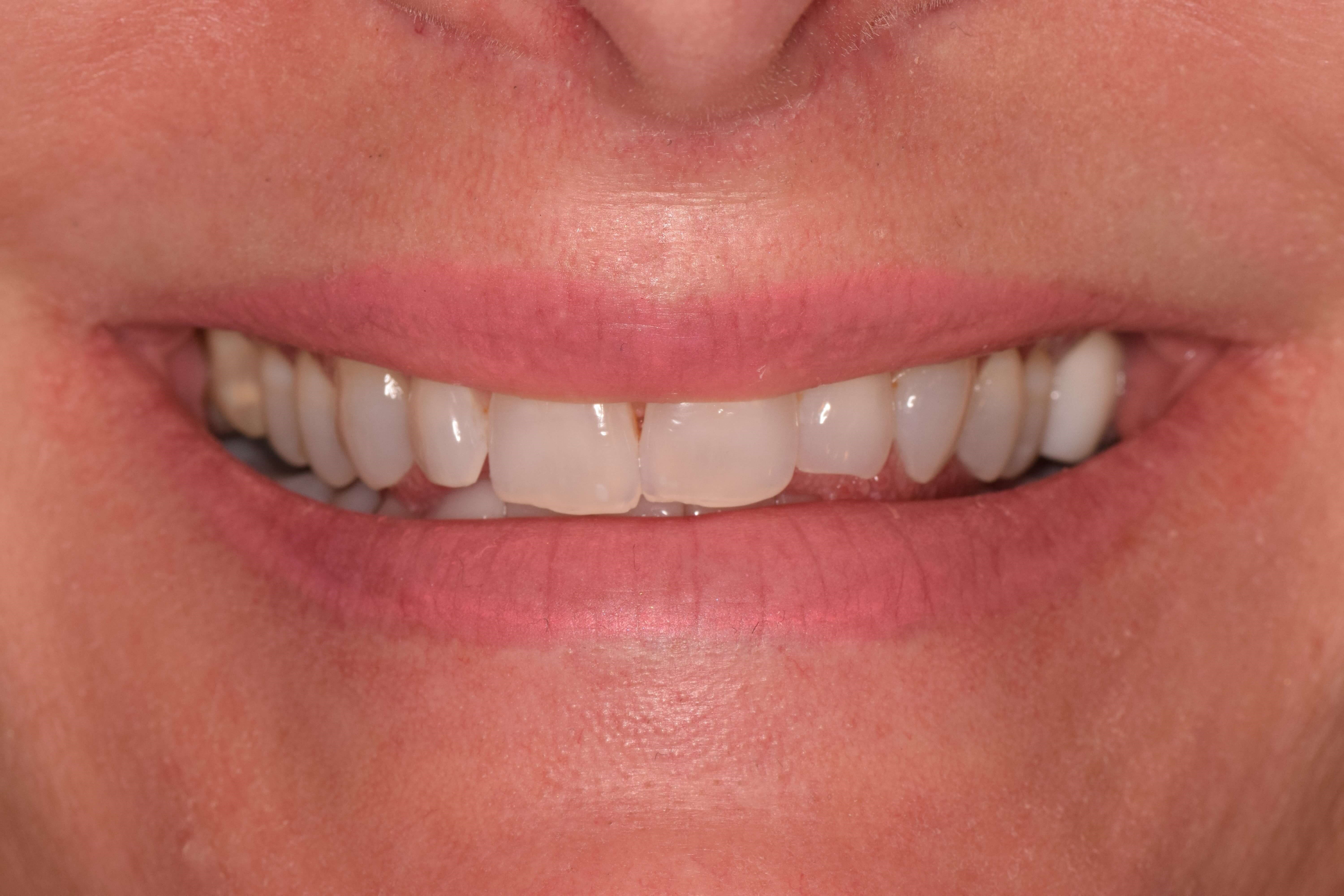 Porcelain Crowns and Veneers Before