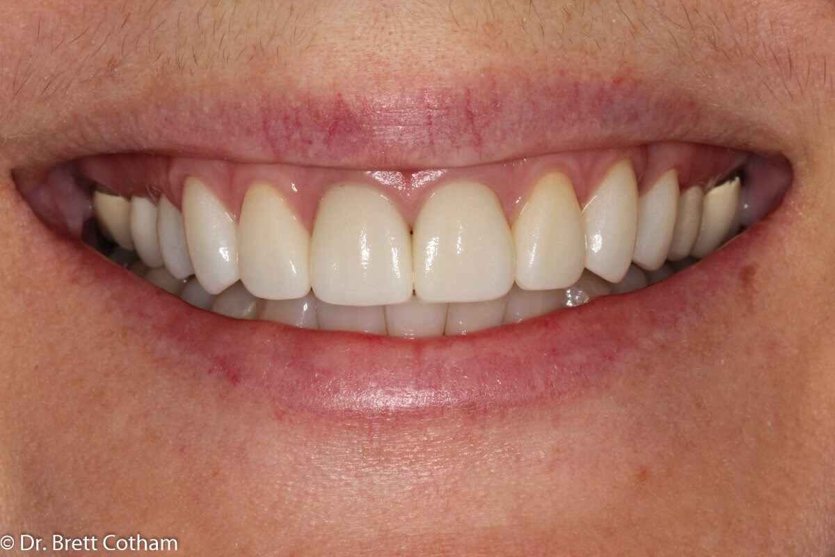 Before and After ZOOM! Whitening & Smile Makeover & Crown ... Before and After ZOOM! Whitening & Smile Makeover & Crown ...