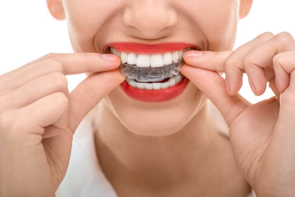 about invisalign