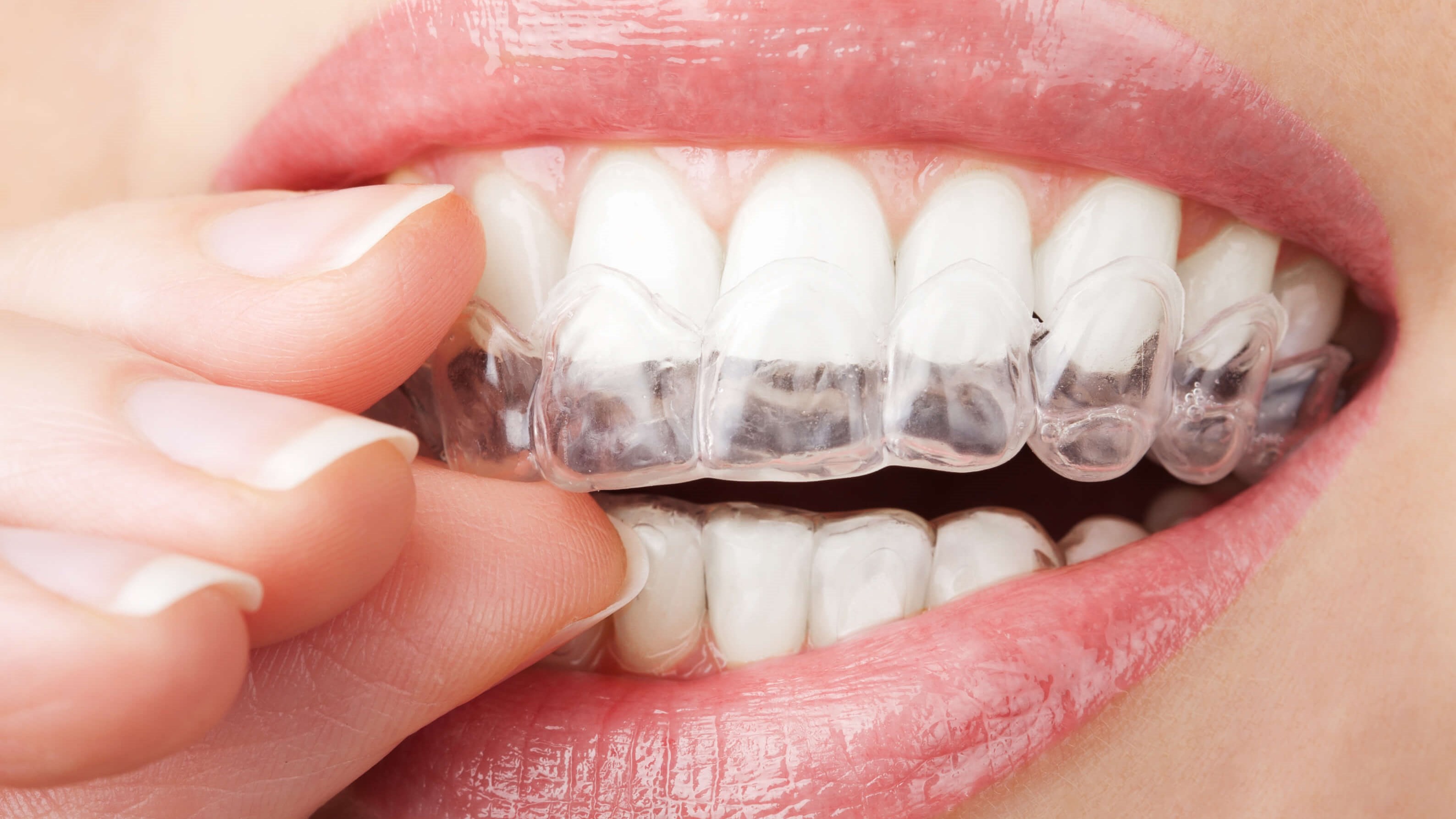 woman holding aligners