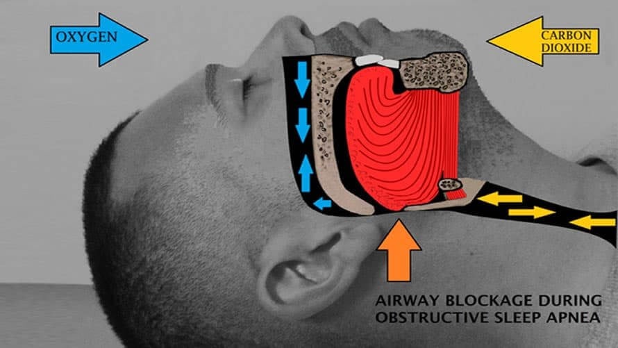 Airway Obstruction